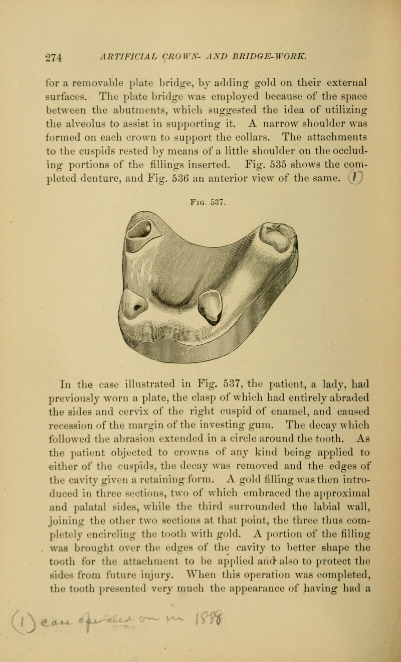 for a removable plate bridge, by adding gold on their external surfaces. The plate bridge was employed because of the space between the abutments, which suggested the idea of utilizing the alveolus to assist in supporting it. A narrow shoulder was formed on each crown to support the collars. The attachments to the cuspids rested by means of a little shoulder on the occlud- ing portions of the fillings inserted. Fig. 535 shows the com- pleted denture, and Fig. 536 an anterior view of the same. ) Fig. 537. In the case illustrated in Fig. 537, the patient, a lady, had previously worn a plate, the clasp of which had entirely abraded the sides and cervix of the right cuspid of enamel, and caused recession of the margin of the investing gum. The decay which followed the abrasion extended in a circle around the tooth. As the patient objected to crowns of any kind being applied to either of the cuspids, the decay was removed and the edges of ili'' cavity given a retaining form. A gold filling was then intro- duced in three Bections, two of which embraced the approximal and palatal -ides, while the third surrounded the labial wall, joining the other two sections at that point, the tine,, thus com- pletely encircling the tooth with gold. A portion of the filling was broughl over the edges of the cavity to better shape the tooth for the attachment to be applied and also to protect the rides from future injury. When this operation was completed, the tooth presented \>-vy much the appearance of having had a