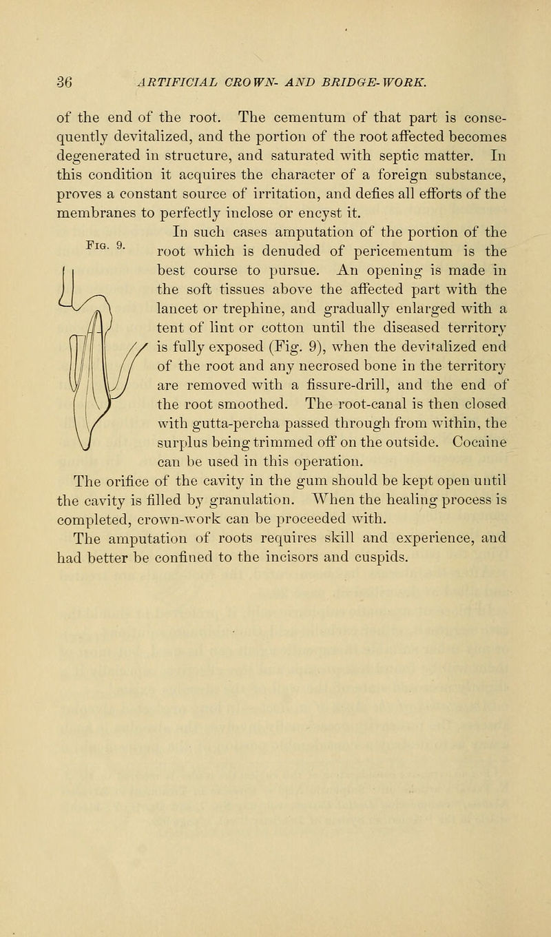 Fig. 9. of the end of the root. The cementum of that part is conse- quently devitalized, and the portion of the root affected becomes degenerated in structure, and saturated with septic matter. In this condition it acquires the character of a foreign substance, proves a constant source of irritation, and defies all efforts of the membranes to perfectly inclose or encyst it. In such cases amputation of the portion of the root which is denuded of pericementum is the best course to pursue. An opening is made in the soft tissues above the affected part with the lancet or trephine, and gradually enlarged with a tent of lint or cotton until the diseased territory is fully exposed (Fig. 9), when the devitalized end of the root and any necrosed bone in the territory are removed with a fissure-drill, and the end of the root smoothed. The root-canal is then closed with gutta-percha passed through from within, the surplus being trimmed ofl on the outside. Cocaine can be used in this operation. The orifice of the cavity in the gum should be kept open until the cavity is filled by granulation. When the healing process is completed, crown-work can be proceeded with. The amputation of roots requires skill and experience, and had better be confined to the incisors and cuspids.