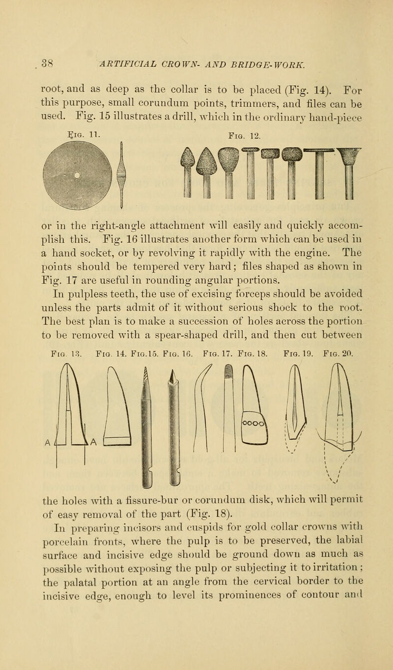 root, and as deep as the collar is to be placed (Fig. 14). For this purpose, small corundum points, trimmers, and files can be used. Fig. 15 illustrates a drill, which in the ordinary hand-piece Big. it. Fig. 12. or in the right-angle attachment will easily and quickly accom- plish this. Fig. 16 illustrates another form which can be used in a hand socket, or by revolving it rapidly with the engine. The points should be tempered very hard; files shaped as shown in Fig. 17 are useful in rounding angular portions. In pulpless teeth, the use of excising forceps should be avoided unless the parts admit of it without serious shock to the root. The best plan is to make a succession of holes across the portion to be removed with a spear-shaped drill, and then cut between Fig. 1?.. Fig. 14. Fig.15. Fig. 16. Fig. 17. Fig. 18. Fig. 19. Fig. 20. I the holes with a fissure-bur or corundum disk, which will permit of easy removal of the part (Fig. 18). In preparing incisors and cuspids for gold collar crowns with porcelain fronts, where the pulp is to be preserved, the labial surface and incisive edge should be ground down as much as possible without exposing the pulp or subjecting it to irritation; the palatal portion at an angle from the cervical border to the incisive edge, enough to level its prominences of contour and