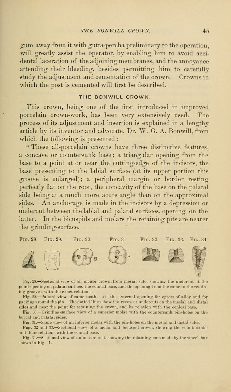 gum awaj from it with gutta-percha preliminary to the operation, will greatly assist the operator, by enabling him to avoid acci- dental laceration of the adjoining membranes, and the annoyance attending their bleeding, besides permitting him to carefully study the adjustment and cementation of the crown. Crowns in which the post is cemented will first be described. THE BONWILL CROWN. This crown, being one of the first introduced in improved porcelain crown-work, has been very extensively used. The process of its adjustment and insertion is explained in a lengthy article by its inventor and advocate. Dr. W. G. A. Bonwill, from which the following is presented :  These all-porcelain crowns have three distinctive features, a concave or countersunk base; a triangular opening from the base to a point at or near the cutting-edge of the incisore, the base presenting to the labial surface (at its upper portion this groove is enlarged); a peripheral margin or border resting perfectly flat on the root, the concavity of the base on the palatal side being at a much more acute angle than on the approximal sides. An anchorage is made in the incisors by a depression or undercut between the labial and palatal surfaces, opening on the latter. In the bicuspids and molars the retaining-pits are nearer the grinding-surface. Fig. 28. Fig. 29. Fig. 30. Fig. 31. Fig. 32. Fig. 33. Fig. 34. Fig. 2S.—Sectional view of an incisor crown, from mesial side, showing the undercut at the point opening on palatal surface, the conical base, and the opening from the same to the retain- ing-grooves, with the e.xact relations. Fig. 29.—Palatal view of same tooth, a is the external opening for egress of alloy and for packing around the pin. The dotted lines show the recess or undercuts on the mesial and distal sides and near the point for retaining the crown, and its relation with the conical ba.se. Fig. 30.—(rrinding-surface view of a superior molar with the countersunk pin-holes on the buccal and palatal sides. Fig. 31.—Same view of an inferior molar with the pin-holes on the mesial and distal sides. Figs. 32 and 33.—Sectional view of a molar and bicuspid crown, showing the countersinks and their relations with the conical base. Fig. 34.—Sectional view of an incisor root, showing the ret.aining-cuts made by the wheel-bur shown in Fig. 41.
