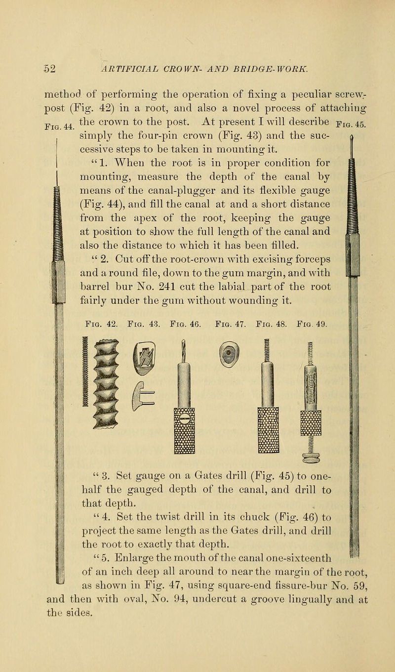 Fig. 42. Fro. 43. Fig. 46. Fig. 47. Fig. 48. Fig. 49. method of performing the operation of fixing a peculiar screw- post (Fig. 42) in a root, and also a novel process of attaching Fig 44 ^^^® crown to the post. At present I will describe -p^Q 45 simply the four-pin crown (Fig. 43) and the suc- cessive steps to be taken in mounting it. I 1. When the root is in proper condition for mounting, measure the depth of the canal by means of the canal-plugger and its flexible gauge (Fig. 44), and fill the canal at and a short distance from the apex of the root, keeping the gauge at position to show the full length of the canal and also the distance to which it has been tilled. 2. Cut ofii'the root-crown with excising forceps and a round file, down to the gum margin, and with barrel bur ISTo. 241 cut the labial part of the root fairly under the gum without wounding it. 3. Set gauge on a Gates drill (Fig. 45) to one- half the gauged depth of the canal, and drill to that depth. 4. Set the twist drill in its chuck (Fig. 46) to project the same length as the Gates drill, and drill the root to exactly that depth. 5. Enlarge the mouth of tlio canal one-sixteenth of an inch deep all around to near the margin of the r as shown in Fig. 47, using square-end fissure-bur No. and then with oval, No. 94, undercut a groove lingually an the sides. H < ^ I oot, 59, d at