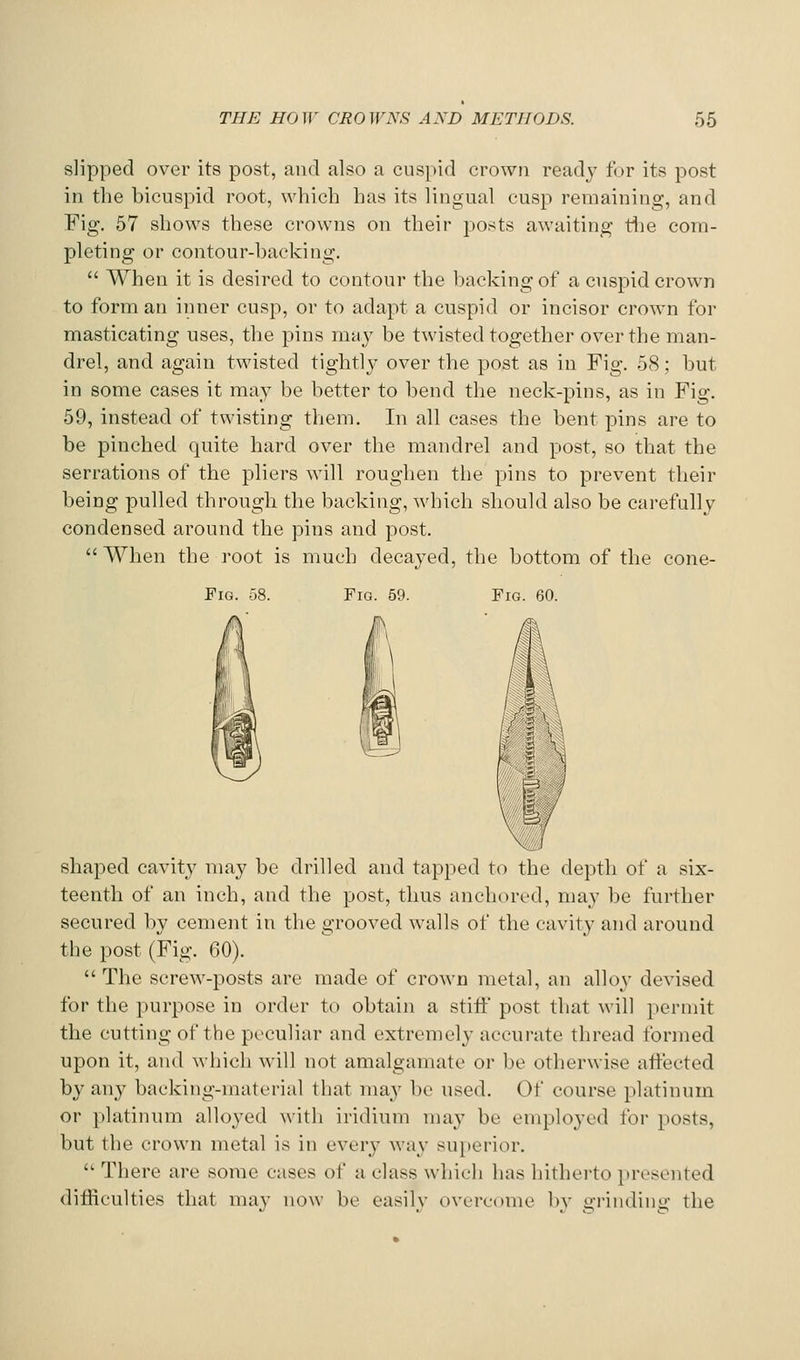 slipped over its post, and also a cuspid crown ready for its post in the bicuspid root, which has its lingual cusp remaining, and Fig. 57 shows these crowns on their posts awaiting tlie com- pleting or contour-backing. When it is desired to contour the backing of a cuspid crown to form an inner cusp, or to adapt a cuspid or incisor crown for masticating uses, the pins nvdy be twisted together over the man- drel, and again twisted tightly over the post as in Fig. 58; but in some cases it may be better to bend the neck-pins, as in Fig. 59, instead of twisting them. In all cases the bent pins are to be pinched quite hard over the mandrel and post, so that the serrations of the pliers will roughen the pins to prevent their being pulled through the backing, which should also be carefully condensed around the pins and post. When the root is much decayed, the bottom of the cone- FiG. 58. Fig. 59. Fig. 60. shaped cavity may be drilled and tapped to the depth of a six- teenth of an inch, and the post, thus anchored, may be further secured by cement in the grooved walls of the cavity and around the post (Fig. 60). The screw-posts are made of crown metal, an alloy devised for the purpose in order to obtain a stiff post that will permit the cutting of the peculiar and extremely accurate thread formed upon it, and wliich will not amalgamate or be otlierwise aftected by any backing-material that may be used. Of course platinum or platinum alloyed with iridium may be employed for posts, but the crown metal is in every way superior. '' There are some cases of a class which has hitherto presented difficulties that may now be easily overcome b}' gi-inding the