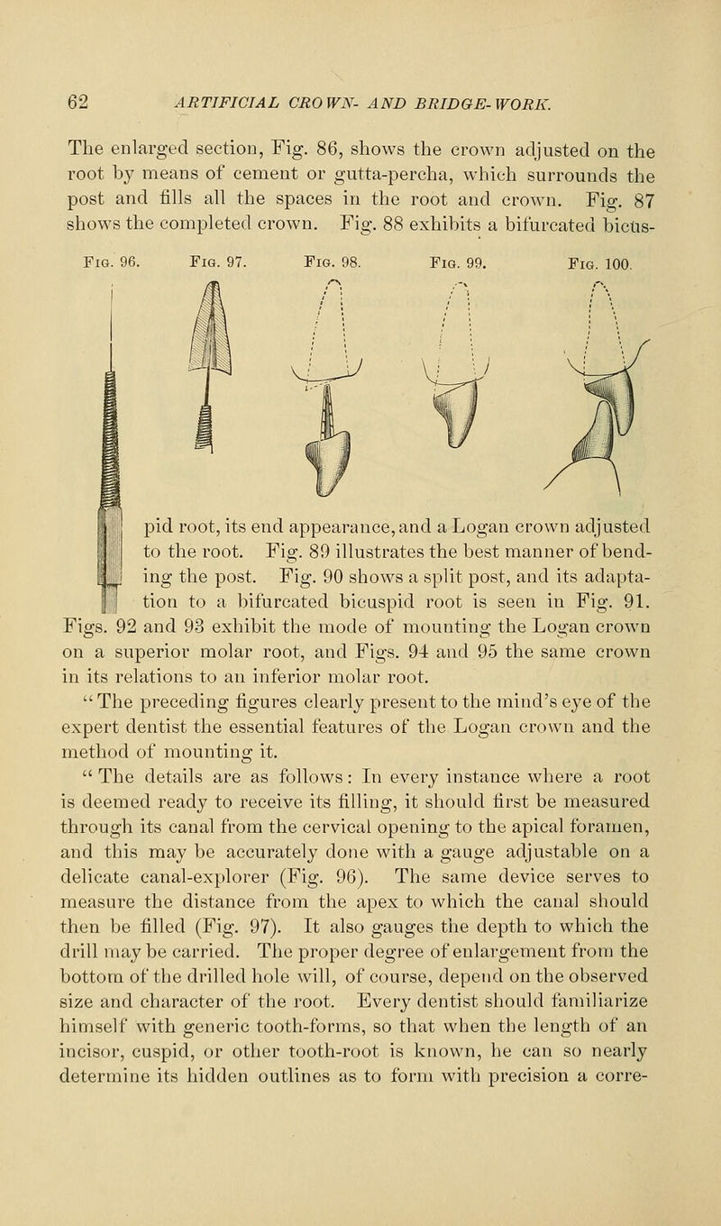 The enlarged section, Fig. 86, shows the crown adjusted on the root by means of cement or gutta-percha, which surrounds the post and tills all the spaces in the root and crown. Fig. 87 shows the completed crown. Fig. 88 exhibits a bifurcated bictis- FiG. 96. Fig. 97. Fig. 98. Fig. 99. Fig. 100. picl root, its end appearance, and a Logan crown adjusted to the root. Fig. 89 illustrates the best manner of bend- ing the post. Fig. 90 shows a split post, and its adapta- tion to a bifurcated bicuspid root is seen in Fig. 91. Figs. 92 and 93 exhibit the mode of mounting the Logan crown on a superior molar root, and Figs. 94 and 95 the same crown in its relations to an inferior molar root.  The preceding figures clearly present to the mind's eye of the expert dentist the essential features of the Logan crown and the method of mounting it.  The details are as follows: In every instance where a root is deemed ready to receive its filling, it should first be measured through its canal from the cervical opening to the apical foramen, and this may be accurately done with a gauge adjustable on a delicate canal-explorer (Fig. 96). The same device serves to measure the distance from the apex to which the canal should then be filled (Fig. 97). It also gauges the depth to which the drill may be carried. The proper degree of enlargement from the bottom of the drilled hole will, of course, depend on the observed size and character of the root. Every dentist should familiarize himself with generic tooth-forms, so that when the length of an incisor, cuspid, or other tooth-root is known, he can so nearly determine its hidden outlines as to form with precision a corre-