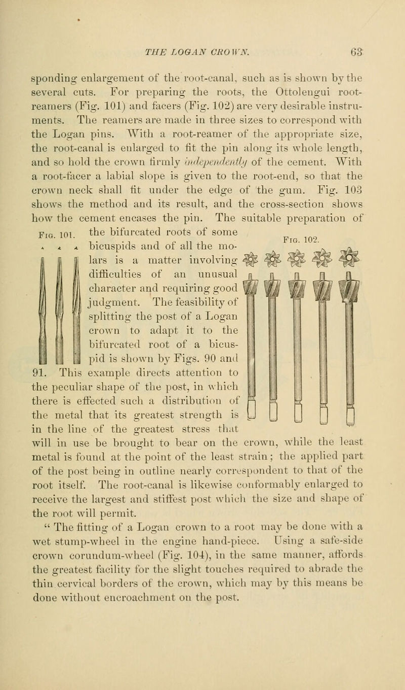 Fig. 102. sponding enlargement of the root-eanal, such as is shown by the several cuts. For preparing the roots, the Ottolengui root- reamers (Fig. 101) and facers (Fig. 102) are very desirable instru- ments. The reamers are made in three sizes to correspond with the Logan pins. With a root-reamer of the appropriate size, the root-canal is enlarged to tit the pin along its whole length, and so hold the crown tirmly iixlependentb/ of the cement. With a root-tacer a labial slope is given to the root-end, so that the crown neck shall lit under the edge of the gum. Fig. 103 shows the method and its result, and the cross-section shows how the cement encases the pin. The suitable preparation of Fig. 101. the bifurcated roots of some < A bicuspids and of all the mo- lars is a matter involving difficulties of an unusual character and requiring good iudo-ment. The feasibilitv of splitting the post of a Logan crown to adapt it to the bifurcated root of a bicus- pid is shown hy Figs. 90 ami This example directs attention to the peculiar shape of the post, in which there is effected such a distribution ut the metal that its greatest strength is in the line of the greatest stress that will in use be brought to bear on the crown, while the least metal is found at the point of the least strain; the apphed part of the post being in outline nearly correspondent to that of the root itself. The root-canal is likewise conformably enlarged to receive the largest and stiffest post which the size and shape of the root will permit.  The fitting of a Logan crown to a root may be done with a wet stump-wheel in the engine hand-piece. Using a safe-side crown corundum-wheel (Fig. 104), in the same manner, affords the greatest facility for the slight touches required to abrade the thin cervical borders of the crown, which may by this means be done without encroachment on the post. 91 D 0