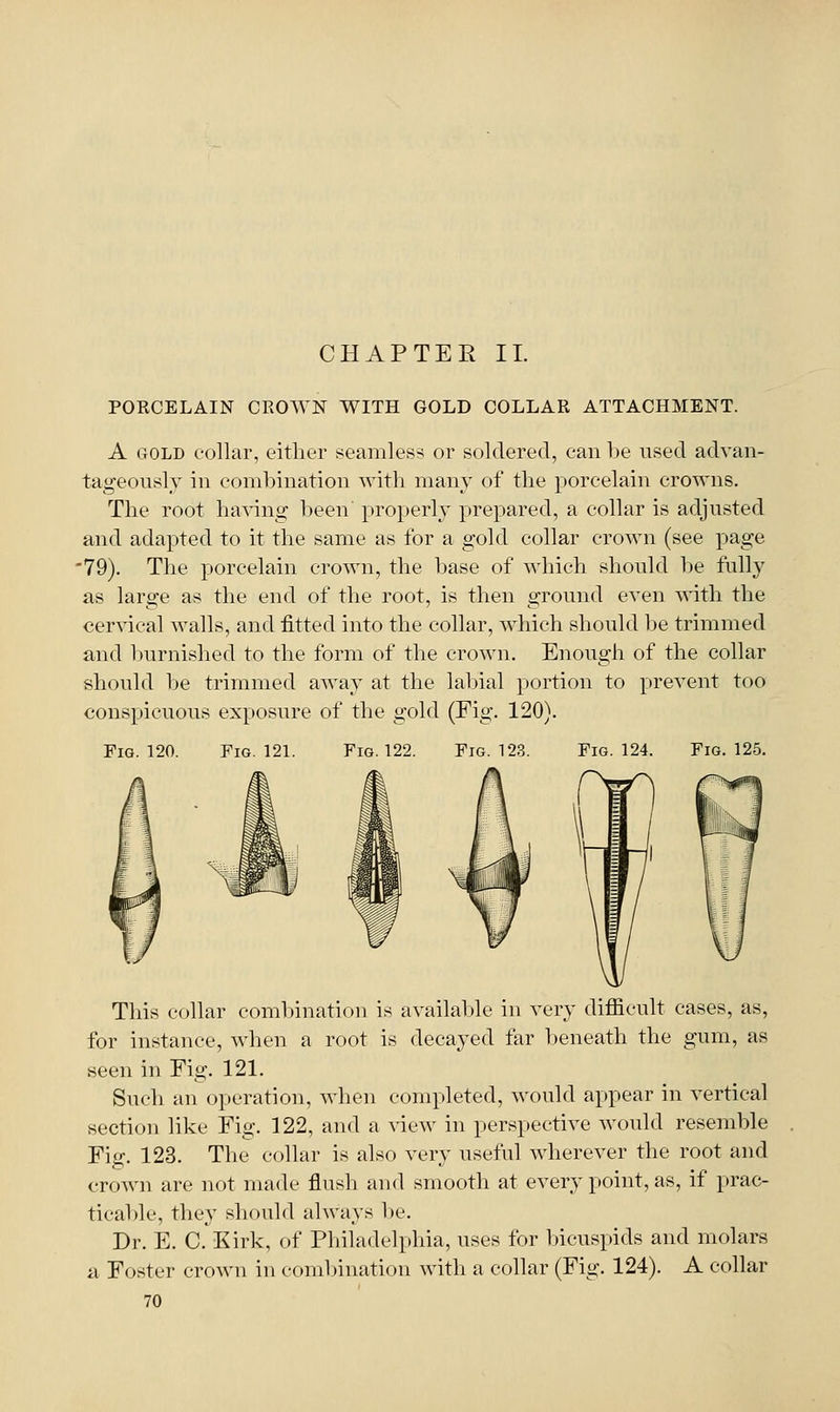 PORCELAIN CROWN WITH GOLD COLLAR ATTACHMENT. A GOLD collar, either seamles-^ or soldered, can be used advan- tageously in combination witli many of the porcelain crowns. The root having been properly prepared, a collar is adjusted and adapted to it the same as for a gold collar crown (see page '79). The porcelain crown, the base of which should l)e fully as large as the end of the root, is then ground even \^'ith the cervical walls, and fitted into the collar, which should be trimmed and Ijurnished to the form of the crown. Enough of the collar should be trimmed away at the labial portion to Y)revent too conspicuous exposure of the gold (Fig. 120). Fig. 124. Fig. 125. Pig. 120. Fig. 121. Fig. 122. Fig. 123. This collar combination is available in very difficult cases, as, for instance, when a root is decayed far beneath the gum, as seen in Fig. 121. Such an operation, when completed, would appear in vertical section like Fig. 122, and a view in perspective would resemble Fig. 123. The collar is also very useful wherever the root and crown are not made flush and smooth at every point, as, if prac- ticaT)le, they should always l)e. Dr. E. C. Kirk, of Philadelphia, uses for Incuspids and molars a Foster crown in combination with a collar (Fig. 124). A collar