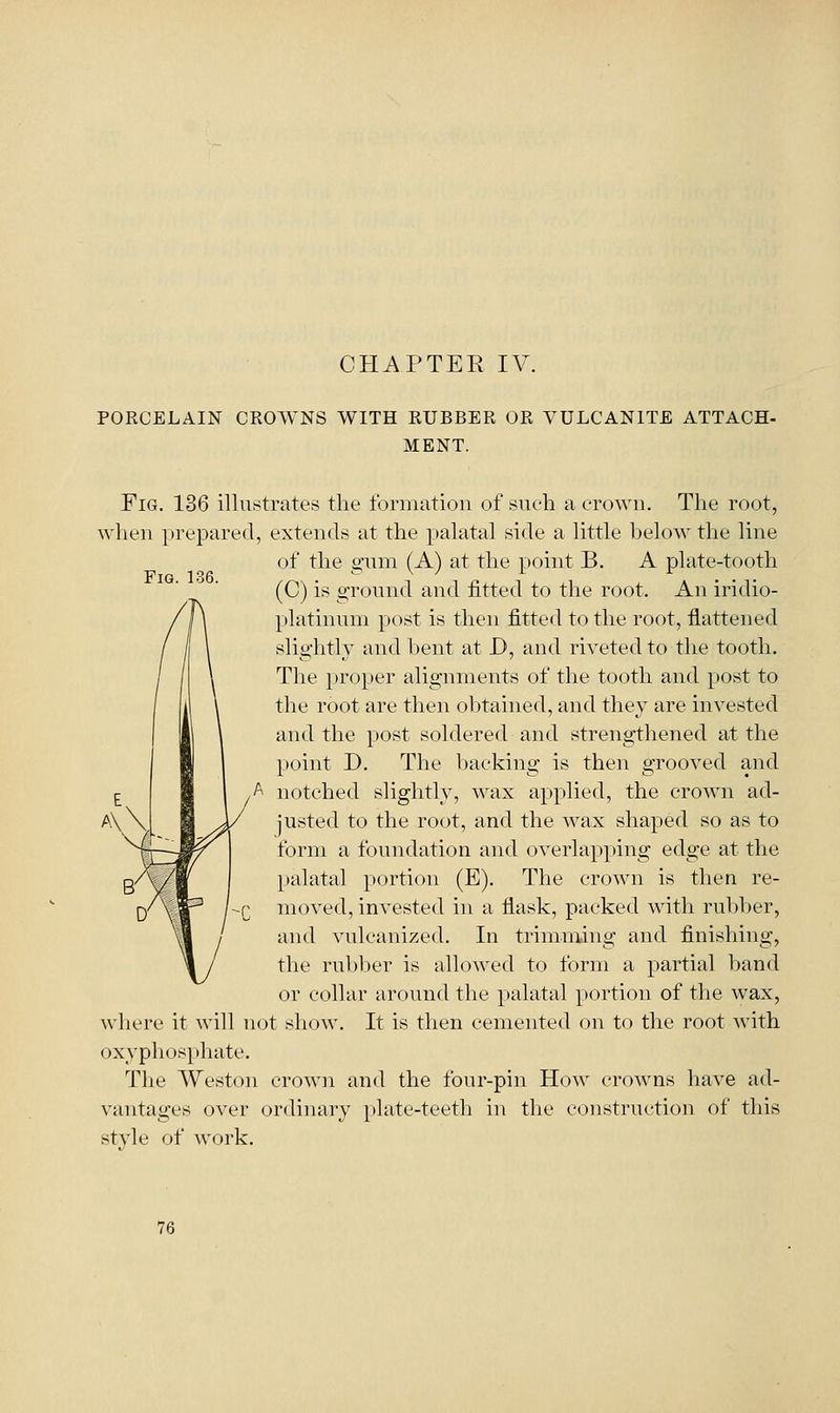 PORCELAIN CROWNS WITH RUBBER OR VULCANITE ATTACH- MENT. Fig. 136. Fig. 136 illustrates the formation of such a crown. The root, when prepared, extends at the palatal side a little below the line of the gum (A) at the point B. A plate-tooth (C) is ground and fitted to the root. An iridio- platinum post is then fitted to the root, flattened slightly and Vjent at D, and riveted to the tooth. The proper alignments of the tooth and post to the root are then obtained, and they are invested and the jtost soldered and strengthened at the point D. The backing is then grooved and / notched slightly, wax applied, the crown ad- justed to the root, and the wax shaped so as to form a foundation and overlapping edge at the }»alatal portion (E). The crown is then re- moved, invested in a flask, packed with rubber, and vulcanized. In trimming and finishing, the ruljber is allowed to form a partial band or collar around the palatal portion of the wax, where it will not show. It is then cemented on to the root Avith oxyphos})hate. The Weston crown and the four-pin How crowns have ad- vantages over ordinary plate-teetli in the construction of this style of work.