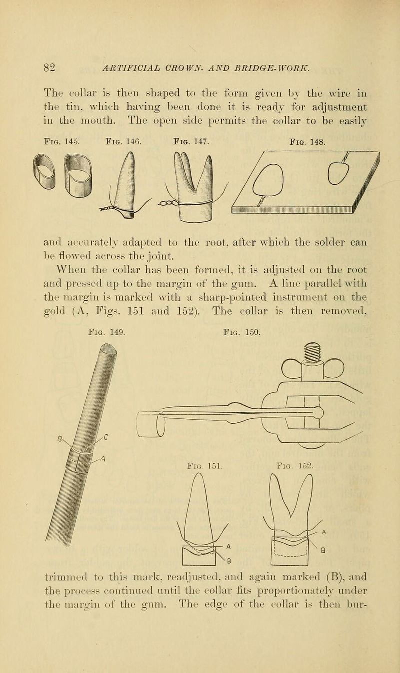 The folla]' is then shaped to the form given h_v the wire in the tin, which haA'ing l)een done it is ready for adjustment in the mouth. The open side permits the collar to be easily Fig. 145. Tig. 146. Fig. 147. Fig. 148. and accurately adapted to the root, after which the solder can be flowed across the joint. When the collar has been ff)rmed, it is adjusted on the root and pressed up to the margin of the gum. A line parallel with the margin is marked with a sharp-pointed instrument on the gold (A, Figs. 151 and 152). The collar is then removed, Fig. 149. Fig. 150. cro Fig- 151. Fig. 152. trimmed to this mark, readjusted, ami again marked (B), and the process continued until the collar fits proportionately under the mar.u'in of the gum. The edge of the collar is then l)nr-