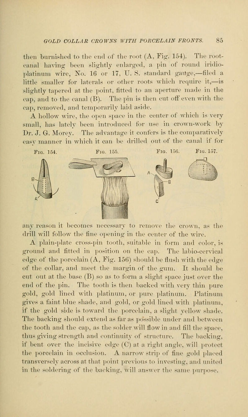 tlic'ii bnrnisliod to the end of the root (A, Fig. 154). Tlie I'oot- canal liaving l:)een sliglitlj enlarged, a pin of round iridio- platinum wdre, ISTo. 16 or 17, U. S. standard gaitge,—tiled a little smaller for laterals or other roots wliieli require it,—is slightly tapered at the point, titted to an aperture made in the cap, and to the canal (B). The pin is then cut off even with the cap, removed, and tem])orarily laid aside. A liollow Avire, tlic o]ien space in the center of which is very small, has lately been intro(hiced for use in crown-work by Dr. J. G. Morey. The advantage it confers is the comparatively easv manner in which it can l)e drilled out of tlie canal if for Fig. 154. Fig. 155. Fig. 156. any reason it becomes necessary to remove the crown, as the drill will follow the tine opening in the center of the wire. A plain-plate cross-pin tooth, suitable in form and color, is groinid and fitted in position on the ca]). The lal)io-cervical edge of the jiorcelain (A, Fig. 156) should l)e flush with the vilga of the collar, and meet the margin of the gum. It should be cut out at the base (B) so as to form a slight s]>ace Just ovei- the end of the ])in. The tooth is then l)acke(l witli very thin ])ure gold, gold lined A\ith platinum, or pure ])latinnm. Platinum gives a faint l»lue sluule, and gold, or gold lined with ])latinum, if the gold side is toward the porcelain, a slight yellow shade. The backing should extend as far as ])<)ssible under and between the tooth and the cap, as the solder will flow in aiul fill the space, thus giving strength and continuity of structure. The backing, if bent over the incisive edge (C) at a right angle, will ]>rotect the porcelain in occlusion. A nai-row strip of fine gold ]»laced transversely across at that point ]ire\iousto investing, and united in the soldering of the backing, will answer the same purpose.