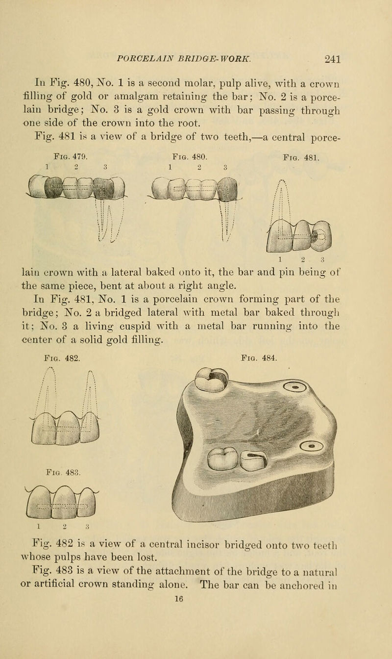 111 Fig. 480, N'o. 1 is a second molar, pulp alive, with a crown filling of gold or amalgam retaining the bar; No. 2 is a porce- lain bridge; No. 3 is a gold crown with bar passing through one side of the crown into the root. Fig. 481 is a view of a bridge of two teeth,—a central porce- FiG. 479. Fig. 480. Fig. 481. lain crown with a lateral baked onto it, the bar and pin being of the same piece, bent at al)out a right angle. In Fig. 481, No. 1 is a porcelain crown forming part of the bridge; No. 2 a bridged lateral with metal bar baked through it; No. 3 a living cuspid with a metal bar running into the center of a solid gold filling. Fig. 482. Fig. 484. Fig. 483. Fig. 482 is a view of a central incisor bridged onto two teeth whose pulps have been lost. Fig. 483 is a view of the attachment of the bridge to a natural or artificial crown standing alone. The bar can be anchored in 16