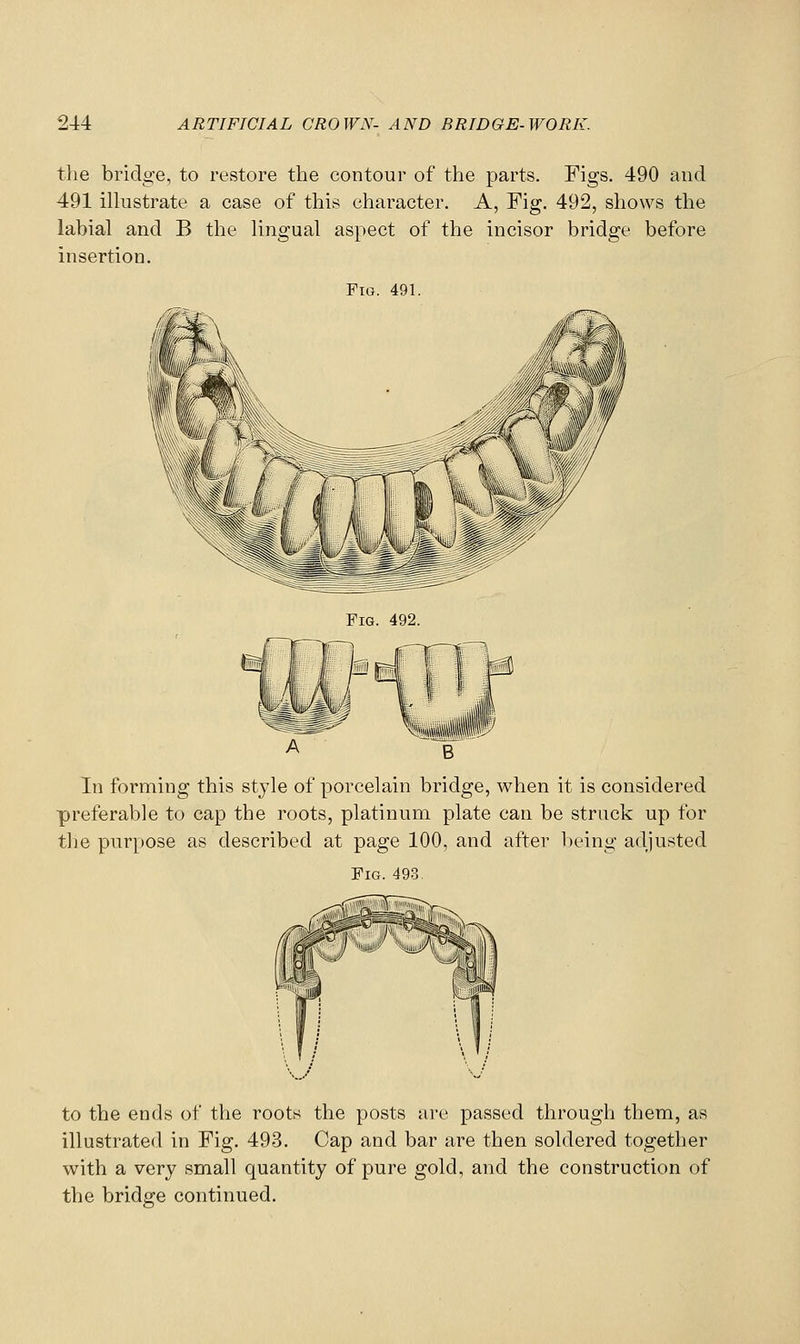 the bridge, to restore the contour of the parts. Figs. 490 and 491 ilkistrate a case of this character. A, Fig. 492, shows the labial and B the Ungual aspect of the incisor bridge before insertion. Fig. 491. Fig. 492. In forming this style of porcelain bridge, when it is considered preferable to cap the roots, platinum plate can be struck up for the purpose as described at page 100, and after lieing adjusted Fig. 493. to the ends of the roots the posts are passed through them, as illustrated in Fig. 493. Cap and bar are then soldered together with a very small quantity of pure gold, and the construction of the bridge continued.