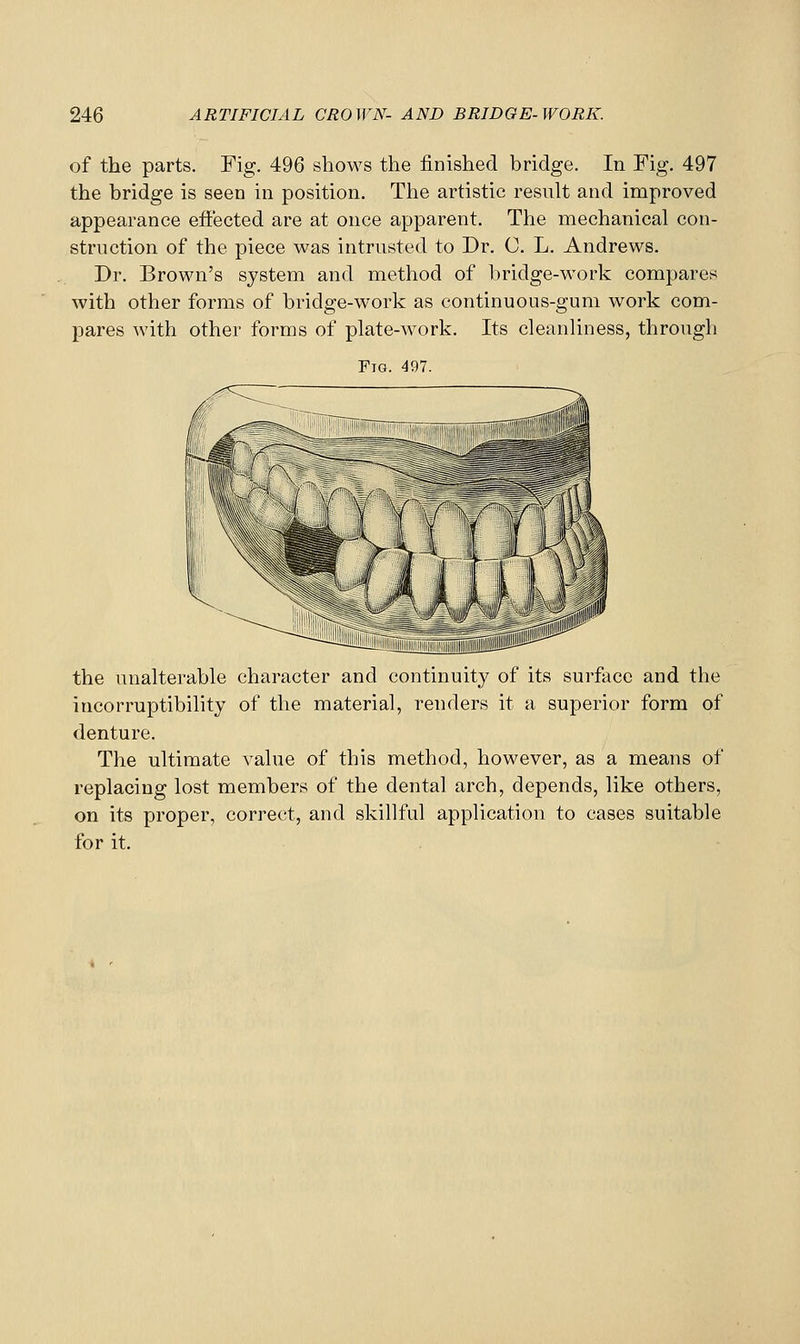 of the parts. Fig. 496 shows the finished bridge. In Fig. 497 the bridge is seen in position. The artistic result and improved appearance effected are at once apparent. The mechanical con- struction of the piece was intrusted to Dr. C. L. Andrews. Dr. Brown's system and method of bridge-work compares with other forms of bridge-work as continuous-gum work com- pares with other forms of plate-work. Its cleanliness, through Fig. 497. the unalterable character and continuity of its surface and the incorruptibility of the material, renders it a superior form of denture. The ultimate value of this method, however, as a means of replacing lost members of the dental arch, depends, like others, on its proper, correct, and skillful application to cases suitable for it. .