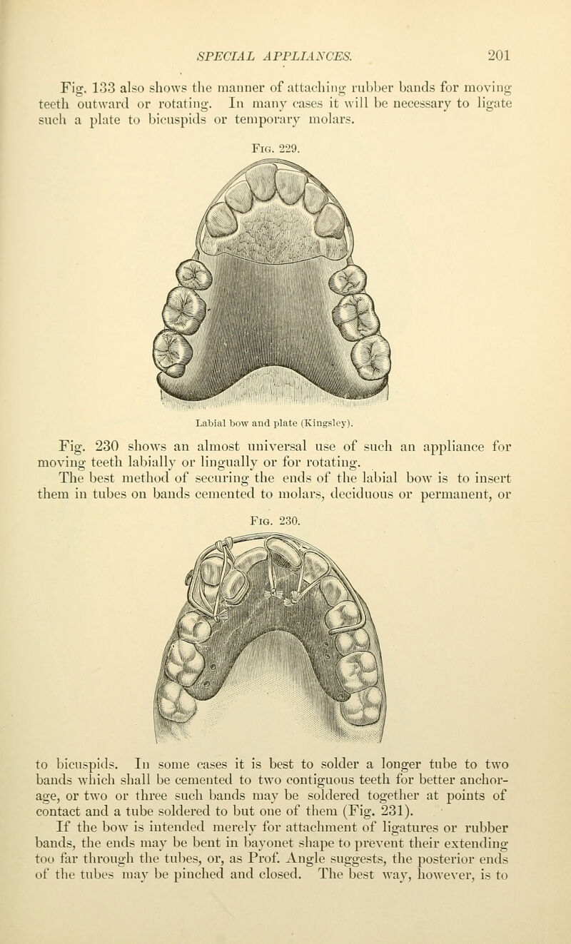 Fig, 133 also shows tlie manner of attaching; rubber bands for moving teeth outward or rotating. In many cases it will be necessary to ligate such a plate to bicuspids or temporary molars. Fig. 229. Labial bow and plate (Kingsley). Fig. 230 shows an almost universal use of such an appliance for moving teeth labially or lingually or for rotating. The best method of securing the ends of the labial bow is to insert them in tubes on bands cemented to molars, deciduous or permanent, or Fig. 230. to bicuspids. In some cases it is best to solder a longer tube to two bands which shall be cemented to two contiguous teeth for better anchor- age, or two or three such bands may be soldered together at points of contact and a tube soldered to but one of them (Fig. 231). If the bow is intended merely for attachment of ligatures or rubber bands, the ends may be bent in bayonet shape to prevent their extending too far through the tubes, or, as Prof. Angle suggests, the posterior ends of the tubes may be pinched and closed. The best way, however, is to