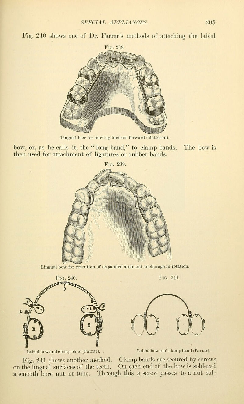 Fig. 240 shows one of Dr. Farrar's methods of attaching the labial Lingual bow for moving incisors forwarrl (Matteson). bow, or, as he calls it, the  long band, to clamp bands. The bow is then used for attachment of ligatures or rubber bands. Fig. 239. Lingual bow for leteution of expanded arch and anchorage m rotation. Fig. 240. Fig. 241. Labial bow and clamp band (Farrar). Labial bow and clamp band (Farrar). , Fig. 241 shows another method. Clamp bands are secured by screws on the lingual surfaces of the teeth. On each end of the bow is soldered a smooth bore nut or tube. Through this a screw passes to a nut sol-