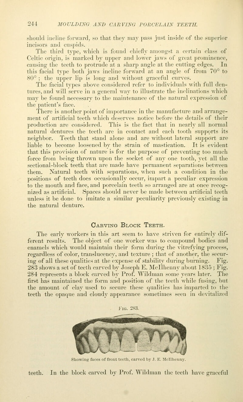 should incline forward, so that they may pass just inside of the superior incisors and cuspids. The third type, which is found chiefly amongst a certain class of Celtic origin, is marked by upper and lower jaws of great j)rominence, causing the teeth to protrude at a sharp angle at the cutting edges. In this facial type both jaws incline forward at an angle of from 70° to 80° ; the upper lip is long and without graceful curves. The facial types above considered refer to individuals with full den- tures, and will serve in a general way to illustrate the in(dinations which may be found necessary to the maintenance of the natural expression of the patient's face. There is another point of importance in the manufacture and arrange- ment of artificial teeth which deserves notice before the details of their production are considered. This is the fact that in nearly all normal natural dentures the teeth are in contact and each tooth supports its neighbor. Teeth that stand alone and are without lateral support are liable to become loosened by the strain of mastication. It is evident that this provision of nature is for the purpose of preventing too much force from being thrown upon the socket of any one tooth, yet all the sectional-block teeth that are made have permanent separations between them. Natural teeth with separations, when such a condition in the positions of teeth does occasionally occur, impart a peculiar expression to the mouth and face, and porcelain teeth so arranged are at once recog- nized as artificial. Spaces should never be made between artificial teeth unless it be done to imitate a similar peculiarity previously existing in the natural denture. Carving Block Teeth. The early workers in this art seem to have striven for entirely dif- ferent results. The object of one worker was to compound bodies and enamels which would maintain their form during the vitrefying process, regardless of color, translucency, and texture ; that of another, the secur- ing of all these qualities at the expense of stability during burning. Fig. 283 shows a set of teeth carved by Joseph E. Mcllhenny about 1835 ; Fig. 284 represents a block carved by Prof. AVildman some years later. The first has maintained the form and position of the teeth while fusing, but the amount of clay used to secure these cpialities has imparted to the teeth the opaque and cloudy appearance sometimes seen in devitalized Fig. 283. Showing faces of front teeth, carved by J. E. Mcllhenny. teeth. In the block carved by Prof. Wildman tlie teeth have graceful