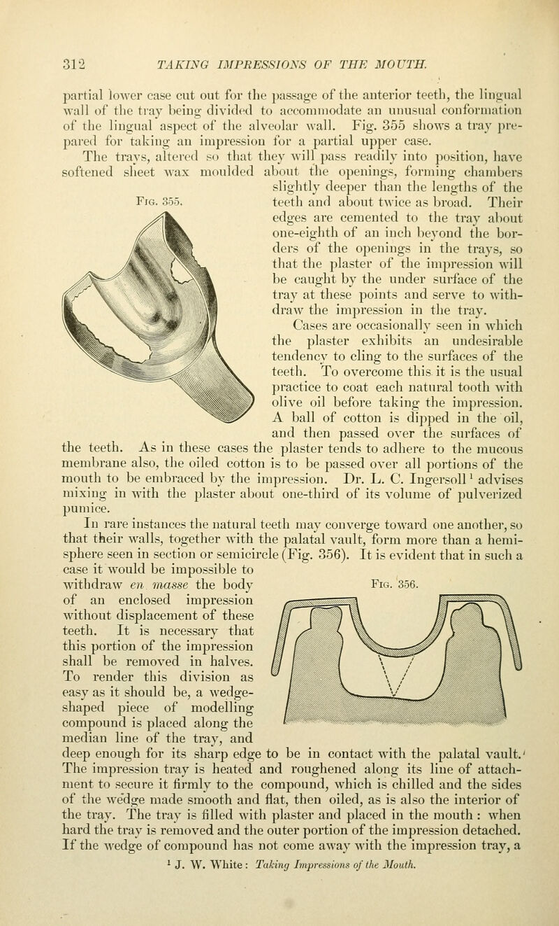 Fig. partial lower case cut out for the passage of the anterior teeth, the lingual wall of the tray being divided to accommodate an unusual conformation of the lingual aspect of the alveolar wall. Fig. 355 shows a tray pre- pared for taking an impression for a partial upper case. The trays, altered so that they will pass readily into position, have softened sheet wax moulded about the openings, forming chambers slightly deeper than the lengths of the teeth and about twice as broad. Their edges are cemented to the tray about one-eighth of an inch beyond the bor- ders of the openings in the trays, so that the plaster of the impression will be caught by the under surface of the tray at these points and serve to with- draw the impression in the tray. Cases are occasionally seen in which the plaster exhibits an undesirable tendency to cling to the surfaces of the teeth. To overcome this, it is the usual practice to coat each natural tooth with olive oil before taking the impression. A ball of cotton is dipped in the oil, and then passed over the surfaces of the teeth. As in these cases the plaster tends to adhere to the mucous membrane also, the oiled cotton is to be passed over all portions of the mouth to be embraced by the impression. Dr. L. C. Ingersoll ^ advises mixing in with the plaster about one-third of its volume of pulverized pumice. In rare instances the natural teeth may converge toward one another, so that tkeir walls, together with the palatal vault, form more than a hemi- sphere seen in section or semicircle (Fig. 356). It is evident that in such a case it would be impossible to withdraw en masse the body Fig. 356. of an enclosed impression without displacement of these teeth. It is necessary that this portion of the impression shall be removed in halves. To render this division as easy as it should be, a wedge- shaped piece of modelling compound is placed along the median line of the tray, and deep enough for its sharp edge to be in contact with the palatal vault.' The impression tray is heated and roughened along its line of attach- ment to secure it firmly to the compound, which is chilled and the sides of the we'dge made smooth and flat, then oiled, as is also the interior of the tray. The tray is filled with plaster and placed in the mouth : when hard the tray is removed and the outer portion of the impression detached. If the Avedge of compound has not come away with the impression tray, a ^ J. W. Wliite : Taking Impressions of the Mouth. SS^SSSSSSSSSiSSSSSSSSISSSi