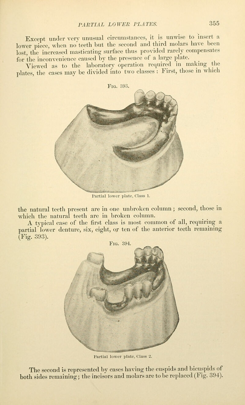 Except under very unusual circumstances, it is unwise to insert a lower piece, when no teeth but the second and third molars have been lost, the increased masticating surface thus provided rarely compensates for the inconvenience caused by the presence of a large plate. Viewed as to the laboratory operation required in makmg the plates, the cases may be divided into two classes : First, those in which Fig. 393. I'artial lower plate, Class 1. the natural teeth present are in one unbroken column; second, those in which the natural teeth are in broken column. A typical case of the first class is most common of all, requiring a partial lower denture, six, eight, or ten of the anterior teeth remaining (Fig. 393). Fig. 394. Partial lower plate, Class 2. The second is represented by cases having the cuspids and bicuspids of both sides remaining; the incisors and molars are to be replaced (Fig. 394).