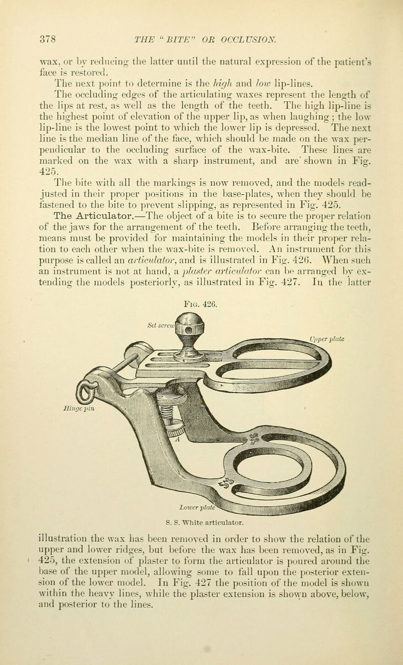 wax. or by rednciug the latter until the natural expression of the patient's face is restored. The next point to determine is the high and low lip-lines. The occluding edges of the articulating waxes represent the length of the lips at rest, as well as the length of the teeth. The high lip-line is the highest point of elevation of the upper lip, as when laugliing; the low lip-line is the lowest point to which the lower lip is depressed. The next line is the median line of the face, which should be made on the wax per- pendicular to the occluding surface of the wax-bite. These lines are marked on the wax with a sharp instrument, and are shown in Fig. 425. Tlie bite with all the markings is now removed, and the models read- justed in their proper positions in the base-plates, when they should be fastened to the bite to prevent slipping, as represented in Fig. 425. The Articulator.—The object of a bite is to secure the proper relation of the jaws for the arrangement of the teeth. Before arranging the teeth, means must be provided for maintaining the models in their proper rela- tion to each other when the wax-bite is removed. An instrument for this purpose is called an articulator, and is illustrated in Fig. 426. When such an instrument is not at hand, a plaster articulator can be arranged by ex- tending the models posteriorly, as illustrated in Fig. 427. In the latter Fig. 426. Upper plate Hinge S. S. White articulator. illustration the wax has been removed in order to show the relation of the upper and lower ridges, but before the wax has been removed, as in Fig. 425, the extension of plaster to form the articulator is poured around the base of the upper model, allowing some to fall upon the posterior exten- sion of the lower model. In Fig. 427 the position of the model is shown within the heavy lines, Mhile the pla^ster extension is shown above, below, and posterior to the lines.