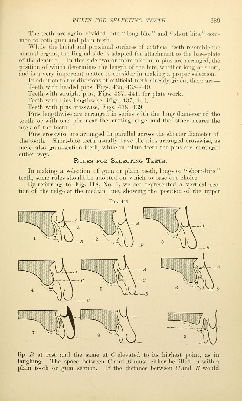 The teeth are again divided into ''long bite and short bite, com- mon to both gum and plain teeth. While the labial and proximal surfaces of artificial teeth resemble the normal organs, the lingnal side is adapted for attachment to the base-plate of the denture. In tiiis side two or more platinum pins are arranged, the position of which determines the length of the bite, whether long or short, and is a very important matter to consider in making a proper selection. In addition to the divisions of artificial teeth already given, there are— Teeth with headed pins, Figs. 435, 438-440. Teeth with straight pins. Figs. 437, 441, for plate work. Teeth with pins lengthwise, Figs. 437, 441. Teeth with pins crosswise. Figs. 438, 439. Pins lengthwise are arranged in series with the long diameter of the tooth, or with one pin near the cutting edge and the other nearer the neck of the tooth. Pins crosswise are arranged in parallel across the shorter diameter of the tooth. Short-bite teeth usually have the pins arranged crosswise, as have also gum-section teeth, while in plain teeth the pins are arranged either way. Rules for Selecting Teeth. In making a selection of gum or plain teeth, long- or  short-bite  teeth, some rules should be adopted on wdiich to base our choice. By referring to Fig. 418, jS^o. 1, we see represented a vertical sec- tion of the ridge at the median line, showing the position of the upper Fig. 443. lip B at rest, and the same at C elevated to its highest point, as in laughing. The space between C and JB must either be filled in with a plain tooth or gum section. If the distance between (7 and B would