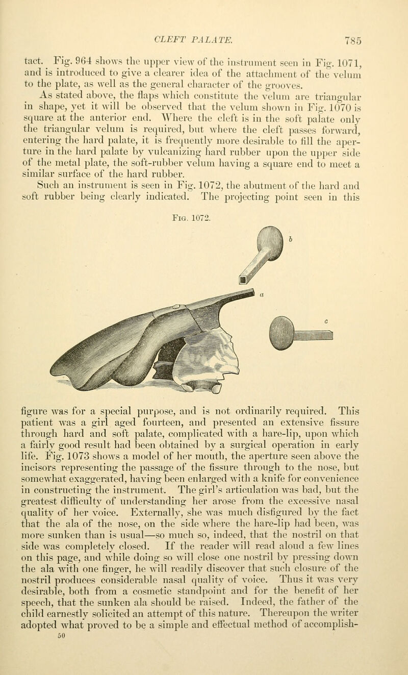 tact. ^ Fig. 964 shows the upper view of the instrument seen in Fig. 1071, and is introduced to give a clearer idea of the attachment of the vchan to the pkite, as well as the general character of the grooves. As stated above, the flaps which constitute the velum are triangular in shape, yet it will be observed that the velum shown in Fig. 1070 is square at the anterior end. Where the cleft is in the soft palate only the triangular velum is required, but where the cleft passes forward, entering the hard palate, it is frequently more desirable to fill the aper- ture in the hard palate by vulcanizing hard rubber upon the upper side of the metal plate, the soft-rubber velum having a square end to meet a similar surface of the hard rubber. Such an instrument is seen in Fig. 1072, the abutment of the hard and soft rubber being clearly indicated. The projecting point seen in this Fig. 1072. figure was for a special purpose, and is not ordinarily required. This patient was a girl aged fourteen, and presented an extensive fissure through hard and soft palate, complicated with a hare-lip, upon which a fairly good result had been obtained by a surgical operation in early life. Fig. 1073 shows a model of her mouth, the aperture seen above the incisors representing the passage of the fissure through to the nose, but somewhat exaggerated, having been enlarged with a knife for convenience in constructing the instrument. The girl's articulation was bad, but the greatest difficulty of understanding her arose from the excessive nasal quality of her voice. Externally, she was much disfigured by the fact that the ala of the nose, on the side where the hare-lip had been, was more sunken than is usual—so much so, indeed, that the nostril on that side was completely closed. If the reader will read aloud a few lines on this page, and while doing so will close one nostril by pressing down the ala with one finger, he will readily discover that such closure of the nostril produces considerable nasal quality of voice. Thus it Was very desirable, both from a cosmetic standpoint and for the benefit of her speech, that the sunken ala should be raised. Indeed, the father of the child earnestly solicited an attempt of this nature. Thereupon the writer adopted what proved to be a simple and effectual method of accomplish- 50