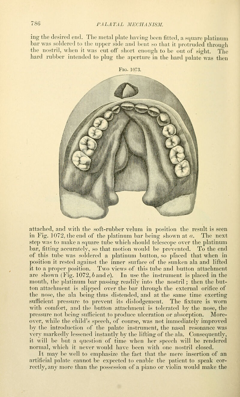 ing the desired end. Tlie metal plate liavino; been fitted, a square platinum bar was soldered to the upper side and beiit so that it protruded throucdi the nostril, when it Avas cut off short enough to be out of sight. The hard rubber intended to plug the aperture in the hard palate was then Fig. 1073. attached, and with the soft-rubber velum in position the result is seen in Fig. 1072, the end of the platinum bar being shown at a. The next step was to make a square tube which should telescope over the platinum bar, fitting accurately, so that motion would be prevented. To the end of this tube was soldered a platinum button, so placed that when in position it rested against the inner surface of the sunken ala and lifted it to a proper position. Two views of this tube and button attachment are shown (Fig. 1072,6 and c). In use the instrument is placed in the mouth, the platinum bar passing readily into the nostril; then the but- ton attachment is slipped over the bar through the external orifice of the nose, the ala being thus distended, and at the same time exerting sufficient pressure to prevent its dislodgement. The fixture is worn with comfort, and the button attachment is tolerated by the nose, the pressure not being sufficient to produce ulceration or absorption. More- over, while the child's speech, of course, was not immediately improved by the introduction of the palate instrument, the nasal resonance was very markedly lessened instantly by the lifting of the ala. Consequently, it will be but a question of time when her speech will be rendered normal, which it never would have been with one nostril closed. It may be well to emphasize the fact that the mere insertion of an artificial palate cannot be expected to enable the patient to speak cor- rectly, any more than the possession of a piano or violin would make the