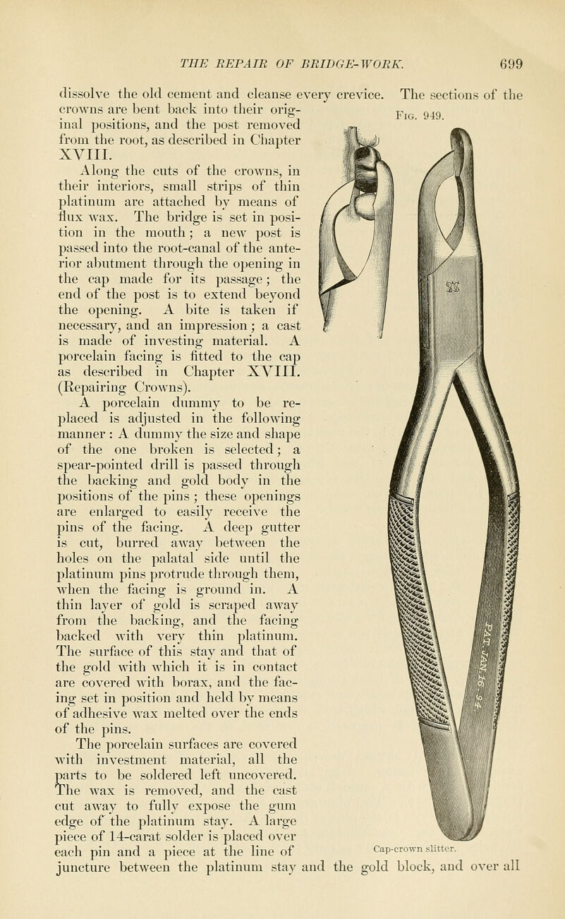 The sections of the Fig. 949. dissolve the old cement and cleanse every crevice, crowns are bent back into their orig- inal positions, and the post removed from the root, as described in Chapter XVIII. Along the cuts of the crowns, in their interiors, small strips of thin platinum are attached by means of flux wax. The bridge is set in posi- tion in the mouth; a new post is passed into the root-canal of the ante- rior abutment through the opening in the cap made for its passage; the end of the post is to extend beyond the opening. A bite is taken if necessary, and an impression; a cast is made of investing material. A porcelain facing is fitted to the cap as described in Chapter XVIII. (Repairing Crowns). A porcelain dummy to be re- placed is adjusted in the following manner : A dummy the size and shape of the one broken is selected; a spear-pointed drill is passed through the backing and gold body in the positions of the pins ; these openings are enlarged to easily receive the pins of the facing, A deep gutter is cut, burred away between the holes on the palatal side until the platinum pins protrude through them, when the facing is ground in. A thin layer of gold is scraped away from the backing, and the facing backed with very thin platinum. The surface of this stay and that of the gold with which it is in contact are covered with borax, and the fac- ing set in position and held by means of adhesive wax melted over the ends of the pins. The porcelain surfaces are covered with investment material, all the parts to be soldered left uncovered. The wax is removed, and the cast cut away to fully expose the gum edge of the platinum stay. A large piece of 14-carat solder is placed over each pin and a piece at the line of juncture between the platinum stay and the gold block, and over all Cap-crown slitter.