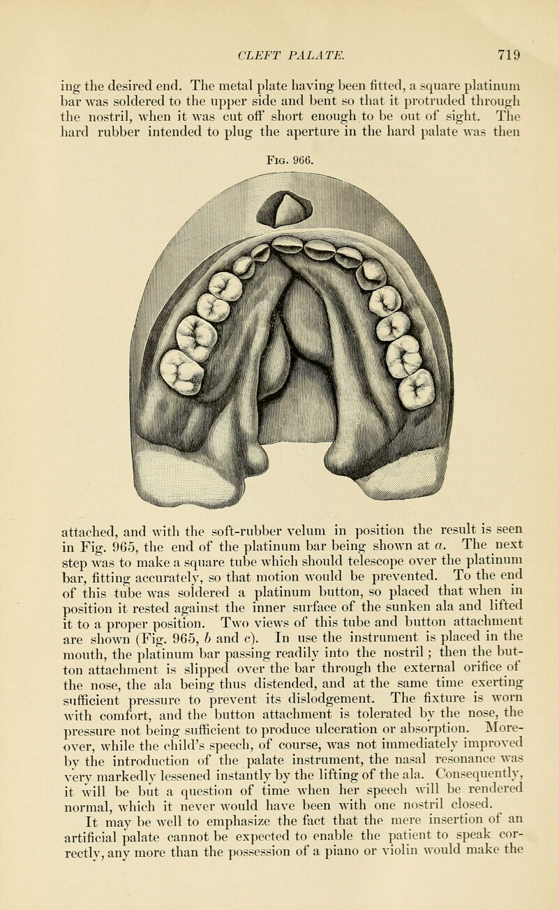 ing the desired end. The metal plate having been fitted, a square platinum bar was soldered to the upper side and bent so that it protruded through the nostril, when it was cut off short enough to be out of sight. The hard rubber intended to plug the aperture in the hard palate was then Fig. 966. UHjliiBgi) attached, and with the soft-rubber velum in position the result is seen in Fig. 965, the end of the platinum bar being shown at a. The next step was to make a square tube which should telescope over the platinum bar, fitting accurately, so that motion would be prevented. To the end of this tube was soldered a platinum button, so placed that when in position it rested against the inner surface of the sunken ala and lifted it to a proper position. Two views of this tube and button attachment are shown (Fig. 965, b and c). In use the instrument is placed in the mouth, the platinum bar passing readily into the nostril; then the but- ton attachment is slipped over the bar through the external orifice of the nose, the ala being thus distended, and at the same time exerting sufficient pressure to prevent its dislodgement. The fixture is worn with comfort, and the button attachment is tolerated by the nose, the pressure not being sufficient to produce ulceration or absorption. More- over, while the child's speech, of course, was not immediately improved by the introduction of the palate instrument, the nasal resonance was very markedly lessened instantly by the lifting of the ala. Consequently, it will be but a question of time when her speech will be rendered normal, which it never would have been with one nostril closed. It may be well to emphasize the fact that the mere insertion of an artificial palate cannot be expected to enable the patient to speak cor- rectly, any more than the possession of a piano or violin would make the