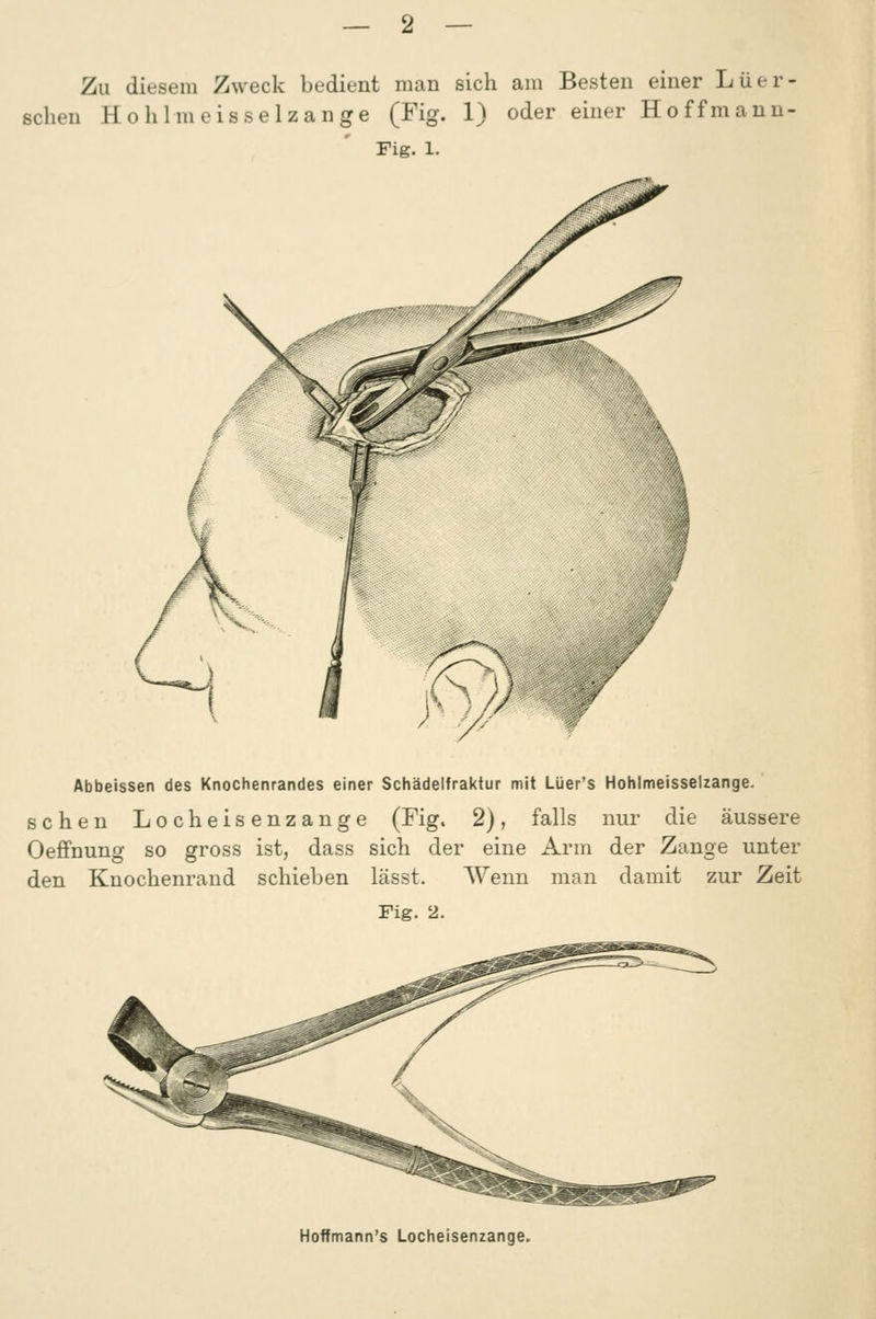 Zu diesem Zweck bedient man sich am Besten einer Lüer- schen H o h 1 m e is se 1 z an ge (Fig. 1) oder einer Hoffmann- Fig. 1. Abbeissen des Knochenrandes einer Schädelfraktur mit Lüer's Hohlmeisselzange. sehen Locheisenzange (Fig. 2), falls nur die äussere Oeffnung so gross ist, dass sich der eine Arm der Zange unter den Knochenrand schieben lässt. Wenn man damit zur Zeit Fig. 2. Hoffmann's Locheisenzange.