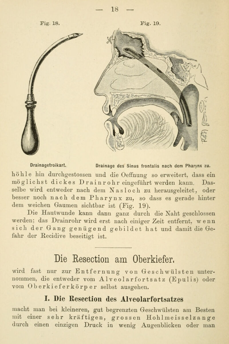 Fig. 18. Fig. 19. Drainagetroikart. Drainage des Sinus frontalis nach dem Pharynx zu. höhle hin durchgestossen und die Oeffnung so erweitert, dass ein möglichst dickes D rai nr ohr eingeführt werden kann. Das- selbe wird entweder nach dem Nasloch zu herausgeleitet, oder besser noch nach dem Pharynx zu, so dass es gerade hinter dem weichen Gaumen sichtbar ist (Fig. 19). Die Hautwunde kann dann ganz durch die Naht geschlossen werden; das Drainrohr wird erst nach einiger Zeit entfernt, wenn sich der Gang genügend gebildet hat und damit die Ge- fahr der E,ecidive beseitigt ist. Die Resection am Oberkiefer. wird fast nur zur Entfernung von Geschwülsten unter- nommen, die entweder vom Alveolarfortsatz (Epulis) oder vom Oberkieferkörper selbst ausgehen. I. Die Resection des Alreolarfortsatzes macht man bei kleineren, gut begrenzten Geschwülsten am Besten mit einer sehr kräftigen, grossen Hohlmeisselz a nge durch einen einzigen Druck in wenig Augenblicken oder man