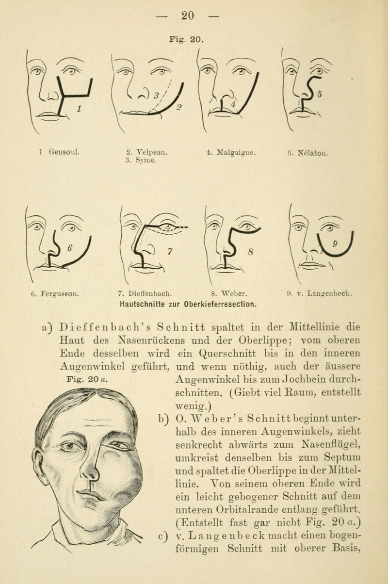 1 Gensoul. 2. Velpeau. 3. Syrae. 4. Malgaigne. 5. N^laton. 6. Fergusson. 7. Dietzenbach. 8. Weber. Hautschnitte zur Oberkieferresection. 9. V. Langenbeck. a) Dieffenbach's Schnitt spaltet in der Mittellinie die Haut des Xasenrückens und der Oberlippe; vom oberen Ende desselben wird ein Querschnitt bis in den inneren Augenwinkel geführt, und wenn nöthig, auch der äussere Fig. 20 a. Augenwinkel bis zum Jochbein durch- schnitten. (Giebt viel Kaum, entstellt wenig.) b) 0. W e b e r' s Schnitt beginnt unter- halb des inneren Augenwinkels, zieht senkrecht abwärts zum Xasenfliigel, umkreist denselben bis zum Septum und spaltet die Oberlippe in der Mittel- linie. Von seinem oberen Ende wird ein leicht gebogener Schnitt auf dem unteren Orbitalrande entlang geführt. (Entstellt fast gar nicht Fig. 20 «.) c) V. L a n g e n b e c k macht einen bogen- förmigen Schnitt mit oberer Basis,