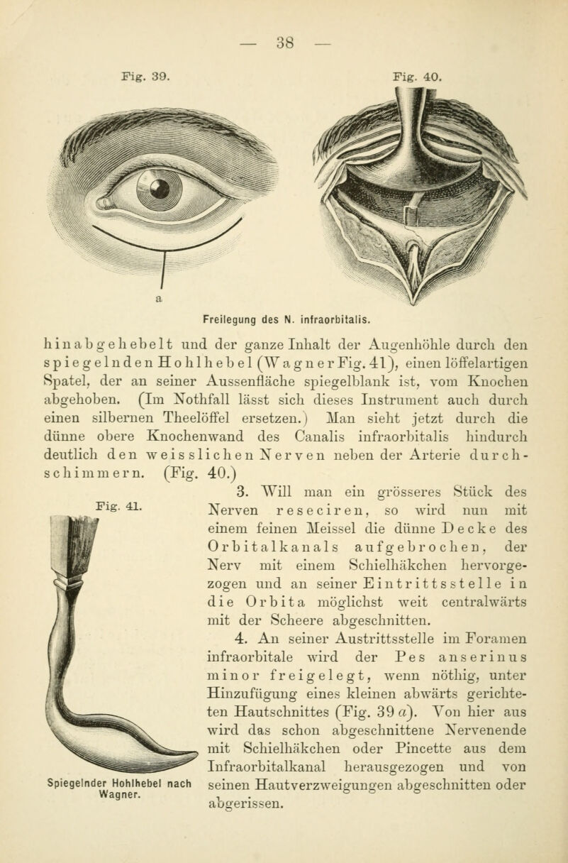 Fig. 39. Fig. 40. Fig. 41. Freilegung des N. infraorbitalis. hin ab gehebelt und der ganze Inhalt der Augenhöhle durch den spiegelndenHohlhebel (W a g n e r Fig. 41), einen löffelartigen Spatel, der an seiner Aussenfläche spiegelblank ist, vom Knochen abgehoben. (Im Nothfall lässt sich dieses Instrument auch durch einen silbernen Theelöffel ersetzen.) Man sieht jetzt durch die dünne obere Knochenwand des Canalis infraorbitalis hindurch deutlich den weisslichenXerven neben der Arterie durch- schimmern. (Fig. 40.) 3. Will man ein grösseres Stück Nerven reseciren, so wird nun einem feinen lleissel die dünne Decke Orbitalkanals aufgebrochen, Nerv mit zogen und die Orbita möglichst weit centralwärts mit der Scheere abgeschnitten. 4. An seiner Austrittsstelle im Foramen infraorbitale wird der Pes anserinus minor freigelegt, wenn nötliig, unter Hinzufügung eines kleinen abwärts gerichte- ten Hautschnittes (Fig. 39«). Von hier aus wird das schon abgeschnittene Nervenende mit Schielhäkchen oder Pincette aus dem Infraorbitalkanal herausgezogen und von seinen Hautverzweigungen abgeschnitten oder des mit des der einem Schielhäkchen hervorge- an seiner Eintrittsstelle in Spiegelnder Hohlhebel nach Wagner. aoo-erissen.