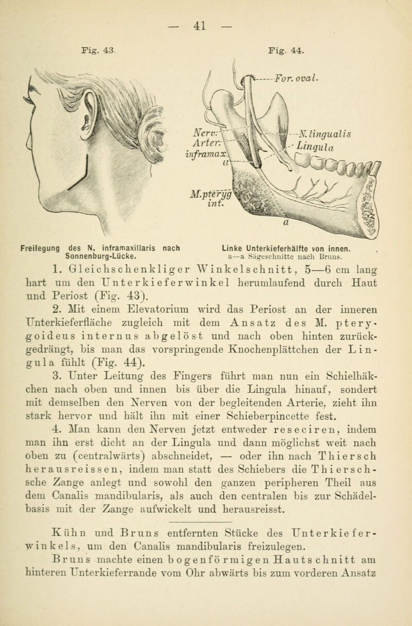 Fig. 43. Fig. 44. For. oval Arter InframaxX M.pteryg ^^,^^ mt. Freilegung des N, inframaxillaris nach Linke Unterkieferhälfte von innen. Sonnenburg-Lücke. a—a Säg'eschnittc uach Bnius. 1. Gleichschenkliger Winkels chnitt j 5—6 cm lang hart um den Unterkieferwinkel herumlaufend durch Haut und Periost (Fig. 43), 2. Mit einem Elevatorium wird das Periost an der inneren Tlnterkieferfläche zugleich mit dem Ansatz des M. ptery- goideus internus abgelöst und nach oben hinten zurück- gedrängt, bis man das vorspringende Knochenplättchen der L i n - gula fühlt (Fig. 44). 3. Unter Leitung des Fingers führt man nun ein Schielhäk- chen nach oben und innen bis über die Lingula hinauf, sondert mit demselben den Xerven von der begleitenden Arterie, zieht ihn stark hervor und hält ihn mit einer Schieberpincette fest. 4. Man kann den Nerven jetzt entweder reseciren, indem man ihn erst dicht an der Lingula und dann möo^lichst weit nach oben zu (centralwärts) abschneidet, — oder ihn nach Thiersch heransreissen, indem man statt des Schiebers die Thiersch- sche Zange anlegt und sowohl den ganzen peripheren Theil aus dem Canalis mandibularis, als auch den centralen bis zur Schädel- basis mit der Zanore aufwickelt und herausreisst. Kühn und Bruns entfernten Stücke des Unter kiefer- wink eis. um den Canalis mandibularis freizuleofen. Bruns machte einen bogenförmigen Hauts chnitt am hinteren Unterkieferrande vom Ohr abwärts bis zum vorderen Ansatz