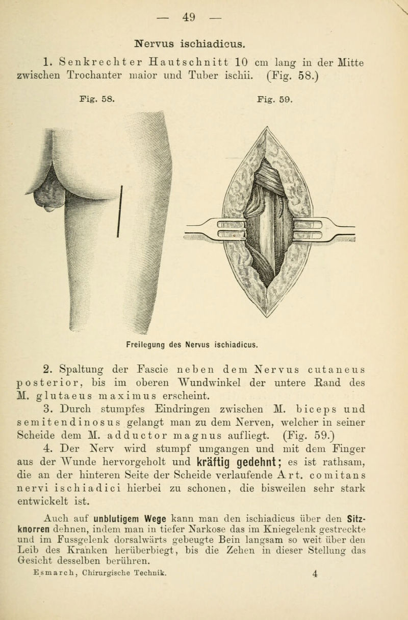 Nervus ischiadicus. 1. Senkrechter Hautschnitt 10 cm lang in der Mitte zwischen Trochanter luaior und Tuber ischii. (Fig. 58.) Fig. 58. Fig. 59. Freilcgung des Nervus ischiadicus. 2. Spaltung der Fascie neben dem Nervus cutaneus posterior, bis im oberen Wundwinkel der untere ßand des glutaeus maximus erscheint. 3. Durch stumpfes Eindringen zwischen M. biceps und semitendinosus gelangt man zu dem Nerven, welcher in seiner Scheide dem M. adductor magnus aufliegt. (Fig. 59.) 4. Der Nerv wird stumpf umgangen und mit dem Finger aus der Wunde hervorgeholt und kräftig gedehnt; es ist rathsam, die an der hinteren Seite der Scheide verlaufende Art. comitans nervi ischiadici hierbei zu schonen, die bisweilen sehr stark entwickelt ist. Auch auf unblutigem Wege kann man den ischiadicus über den Sitz- knorren dehnen, indem man iu tiefer Narkose das im Kniegelenk gestreckte und im Fussgelenk dorsalwärts gebeugte Bein langsam so weit über den Leib des Kranken herüberbiegt, bis die Zehen in dieser Stellung das Gesicht desselben berühren. Esmarch, Chirurgische Techuik. 4