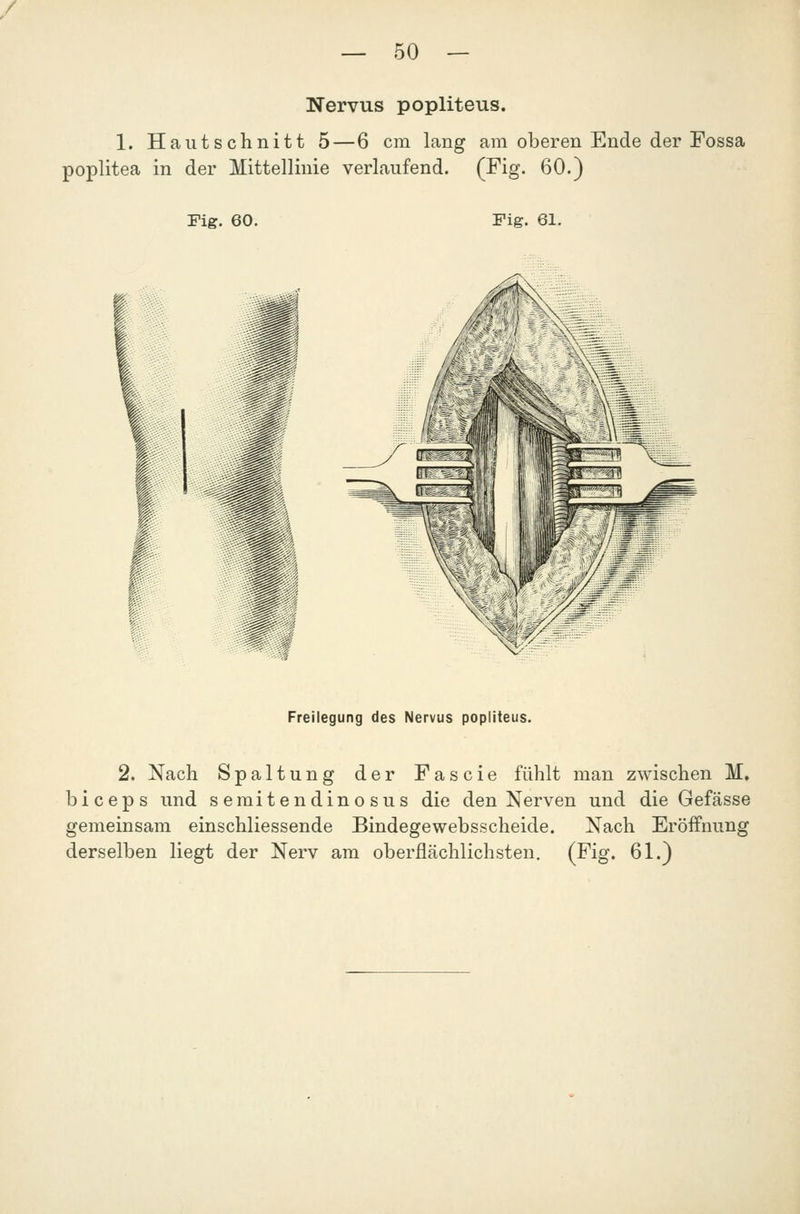 Nervus popliteus. 1. Hautschnitt 5 — 6 cm lang am oberen Ende der Fossa Poplitea in der Mittellinie verlaufend. (Fig. 60.) Fig. 60. Fig. 61. Freilegung des Nervus popliteus. 2. Nach Spaltung der Fascie fühlt man zwischen M. biceps und semitendinosus die den Nerven und die Gefässe gemeinsam einschliessende Bindegewebsscheide. Nach Eröffnung derselben liegt der Nerv am oberflächlichsten. (Fig. 61.)