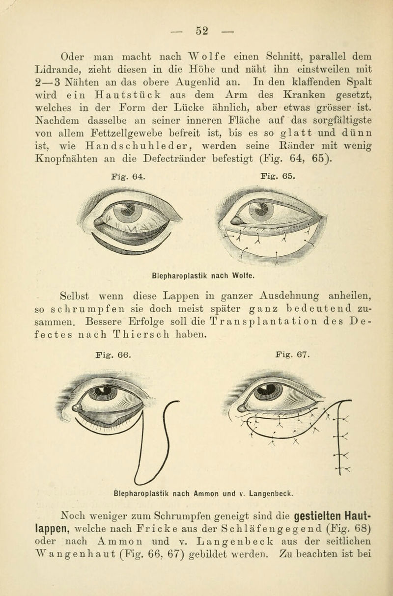 Oder man maclit nach Wolfe einen Schnitt, parallel dem Lidrande, zieht diesen in die Höhe und näht ihn einstweilen mit 2—3 Nähten an das obere Augenlid an. In den klaffenden Spalt wird ein Hautstück aus dem Arm des Kranken gesetzt, welches in der Form der Lücke ähnlich, aber etwas grösser ist. Nachdem dasselbe an seiner inneren Fläche auf das sorgfältigste von allem Fettzellgewebe befreit ist, bis es so glatt und dünn ist, wie Handschuhleder, werden seine Ränder mit wenig Knopfnähten an die Defectränder befestigt (Fig. 64, 65). Fig. 64. rig. 65. Blepharoplastik nach Wolfe. Selbst wenn diese Lappen in ganzer Ausdehnung anheilen, so schrumpfen sie doch meist später ganz bedeutend zu- sammen. Bessere Erfolge soll die Transplantation des De- fectes nach Thiersch haben. Fig. 66. Fig. 67. Blepharoplastik nach Ammon und v. Langenbeck. Noch weniger zum Schrumpfen geneigt sind die gestielten Haut- lappen, welche nach Fricke aus der Schläfengegend (Fig. 68) oder nach Ammon und v. Langenbeck aus der seitlichen AV an genhaut (Fig. 66, 67) gebildet werden. Zu beachten ist bei