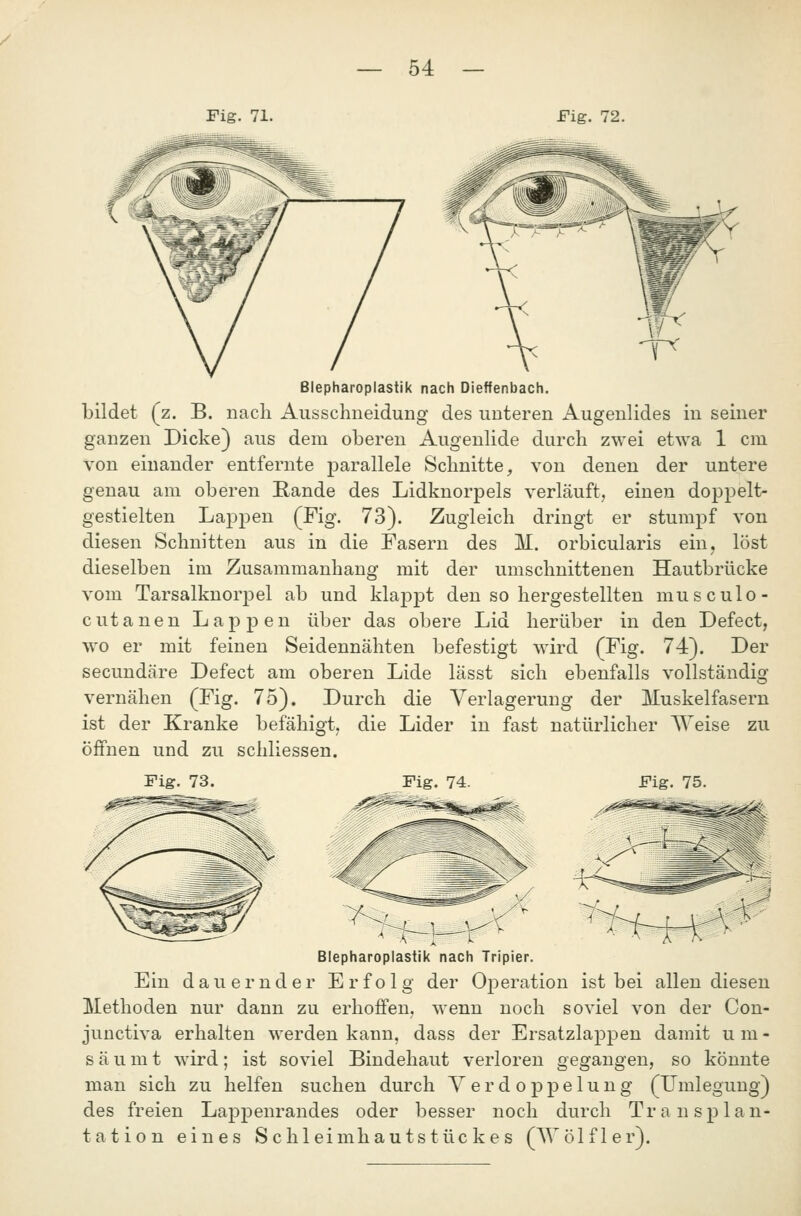 Fig. 71. Fig. 72. Blepharoplastik nach Dieffenbach. bildet (z. B. nach Ausschneidung des unteren Augenlides in seiner ganzen Dicke) aus dem oberen Augenlide durch zwei etwa 1 cm von einander entfernte parallele Schnitte, von denen der untere genau am oberen Rande des Lidknorpels verläuft, einen doppelt- gestielten Lappen (Fig. 73). Zugleich dringt er stumpf von diesen Schnitten aus in die Fasern des M. orbicularis ein, löst dieselben im Zusammanhang mit der umschuittenen Hautbrücke vom Tarsalknorpel ab und klaj)pt den so hergestellten musculo- cutanen Lappen über das obere Lid herüber in den Defect, wo er mit feinen Seidennähten befestigt wird (Fig. 74). Der secundäre Defect am oberen Lide lässt sich ebenfalls vollständig vernähen (Fig. 75). Durch die Verlagerung der Muskelfasern ist der Kranke befähigt, die Lider in fast natürlicher Weise zu öffnen und zu schliessen. Fig. 73. Fig. 74. Fig. 75. E m Blepharoplastik nach Tripier. dauernder Erfolg der Operation ist bei allen diesen Methoden nur dann zu erhoffen, wenn noch soviel von der Con- junctiva erhalten werden kann, dass der Ersatzlappen damit um- säumt wird; ist soviel Bindehaut verloren gegangen, so könnte man sich zu helfen suchen durch Verdoppelung (Umlegung) des freien Lappenrandes oder besser noch durch Transplan- tation eines Schleimhautstückes (AVölfler).