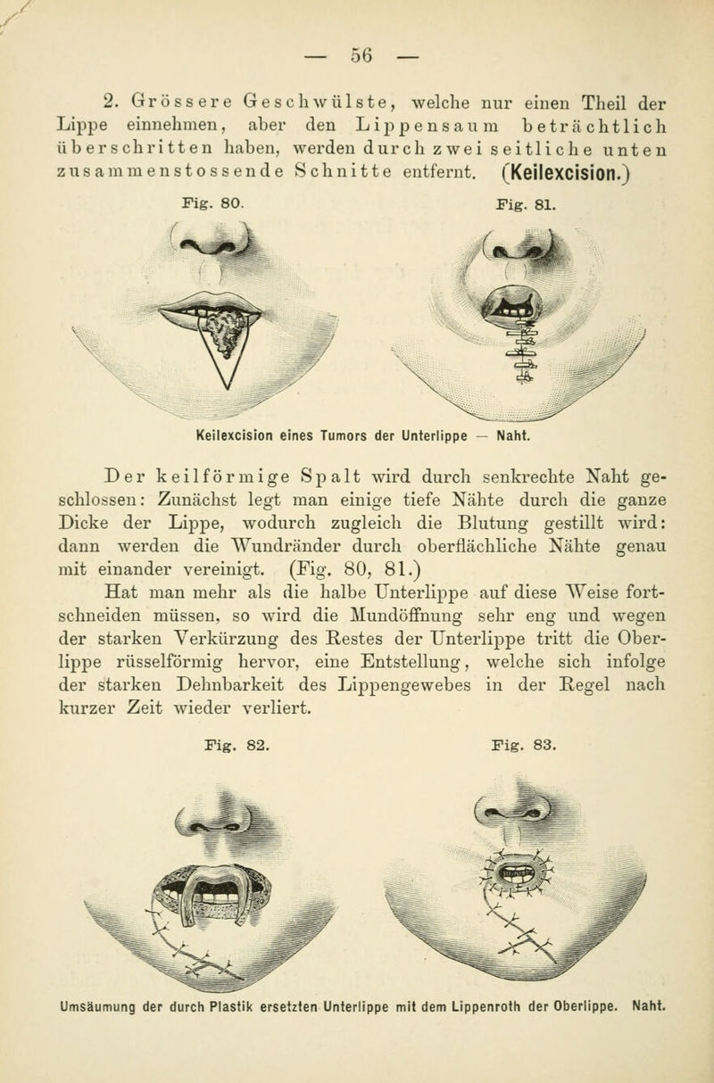 y — 56 — 2. Grössere Geschwülste, welche nur einen Theil der Lippe einnehmen, aber den Lippensaum beträchtlich überschritten haben, werden durch zwei seitliche unten zusammenstossende Schnitte entfernt. (KeileXCision.) Fig. 80. Fig. 81. Keilexcision eines Tumors der Unterlippe — Naht. Der keilförmige Spalt wird durch senkrechte Naht ge- schlossen: Zunächst legt man einige tiefe Nähte durch die ganze Dicke der Lippe, wodurch zugleich die Blutung gestillt wird: dann werden die Wundränder durch oberflächliche Nähte genau mit einander vereinigt. (Fig. 80, 81.) Hat man mehr als die halbe Unterlippe auf diese Weise fort- schneiden müssen, so wird die Mundöffnung sehr eng und wegen der starken Verkürzung des Restes der Unterlippe tritt die Ober- lippe rüsselförmig hervor, eine Entstellung, welche sich infolge der starken Dehnbarkeit des Lippengewebes in der Regel nach kurzer Zeit wieder verliert. Fig. 82. Fig. 83. Umsäumung der durch Plastik ersetzten Unterlippe mit dem Lippenroth der Oberlippe. Naht.