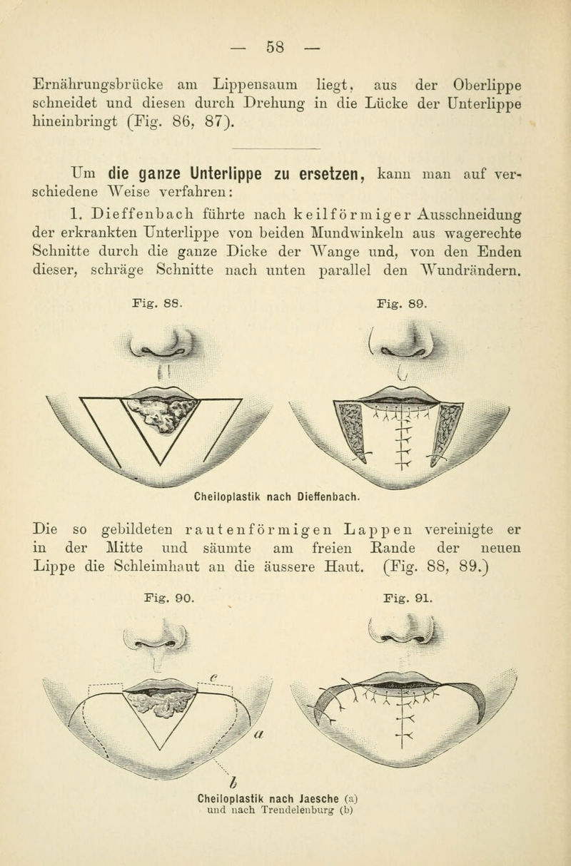 Ernälirungsbrücke am Lippensaum liegt, aus der Oberlippe schneidet und diesen durch Drehung in die Lücke der Unterlippe hineinbringt (Fig. 86, 87). Um die ganze Unterlippe zu ersetzen, kann man auf ver- schiedene Weise verfahren: 1, Dieffenbach führte nach keilförmiger Ausschneidung der erkrankten Unterlippe von beiden Mundwinkeln aus wagerechte Schnitte durch die ganze Dicke der AVange und, von den Enden dieser, schräge Schnitte nach unten parallel den AVundrändern. Fig. 88. Fig. 89. Cheiloplastik nach Dieffenbach. Die so gebildeten rautenförmigen Lappen vereinigte er in der Mitte und säumte am freien E-ande der neuen Lippe die Schleimhaut an die äussere Haut. (Fig. 88, 89.) Fig. 91. Cheiloplastik nach Jaesche (aj und nach Treudelenburg (b)