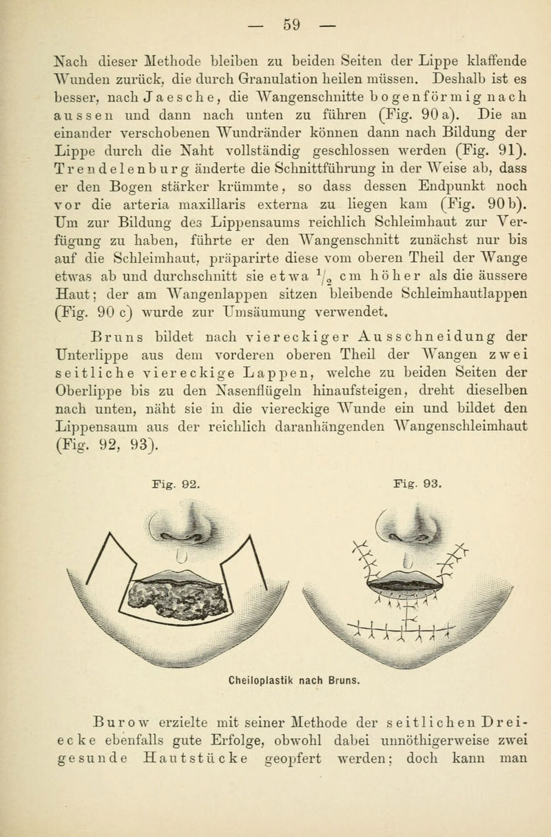 Nach dieser Methode bleiben zu beiden Seiten der Lippe klaffende Wunden zurück, die durch Granulation heilen müssen. Deshalb ist es besser, nach J a e s c h e, die AVangenschnitte bogenförmig nach aussen und dann nach unten zu führen (Fig. 90a). Die an einander verschobenen Wundränder können dann nach Bildung der Lippe durch die Naht vollständig geschlossen werden (Fig. 91). Trendelenburg änderte die Schnittführung in der W'eise ab, dass er den Bogen stärker krümmte, so dass dessen Endpunkt noch vor die arteria maxillaris externa zu liegen kam (Fig. 90b). Um zur Bildung des Lippensaums reichlich Schleimhaut zur Ver- fügung zu haben, führte er den AVangenschnitt zunächst nur bis auf die Schleimhaut, präparirte diese vom oberen Theil der Wange etwas ab und durchschnitt sie etwa -^/^ cm höher als die äussere Haut; der am Wangenlappen sitzen bleibende Schleimhautlappen (Fig. 90 c) wurde zur Umsäumung verwendet. Bruns bildet nach viereckiger Ausschneidung der Unterlippe aus dem vorderen oberen Theil der AYangen zwei seitliche viereckige Lappen, welche zu beiden Seiten der Oberlippe bis zu den Nasenflügeln hinaufsteigen, dreht dieselben nach unten, näht sie in die viereckige Wunde ein und bildet den Lippensaum aus der reichlich daranhängenden AYangenschleimhaut (Fig. 92, 93). Fig. 92. Pig. 93. Cheiloplastik nach Bruns. Bürow erzielte mit seiner Methode der seitlichen Drei- ecke ebenfalls gute Erfolge, obwohl dabei unnöthigerweise zwei gesunde Hautstücke geopfert werden; doch kann man