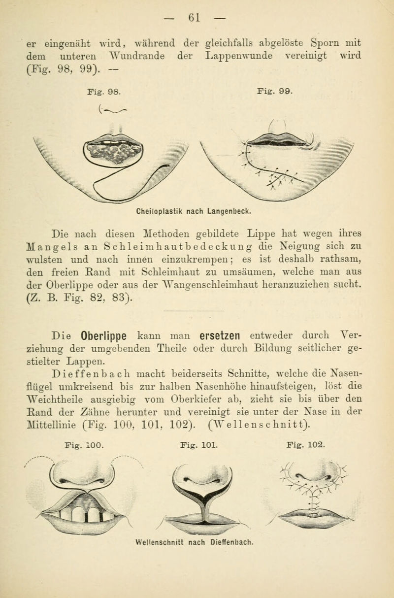 er eingenäht wird, während der gleichfalls abgelöste Sporn mit dem unteren AVundrande der Lappenwunde vereinigt wird (Fig. 98, 99). — Fig. 99. Cheiloplastik nach Langenbeck. Die nach diesen Methoden gebildete Lippe hat wegen ihres Mangels an Schleimhautbedeckung die Neigung sich zu wulsten und nach innen einzukrempen; es ist deshalb rathsam, den freien Eand mit Schleimhaut zu umsäumen, welche man aus der Oberlippe oder aus der AVangenschleimhaut heranzuziehen sucht. (Z. B. Fig. 82. 83). Die Oberlippe kann man ersetzen entweder durch Yer- ziehung der umgebenden Theile oder durch Bildung seitlicher ge- stielter Lappen. Dieffenbach macht beiderseits Schnitte, welche die Nasen- flügel umkreisend bis zur halben Nasenhöhe hinaufsteigen, löst die Weichtheile ausgiebig vom Oberkiefer ab, zieht sie bis über den Rand der Zähne herunter und vereinigt sie unter der Nase in der Mittellinie (Fig. lOo, 101, 102). (T^'ellens c hnitt). Fig. 100. Fig. 101. Fig. 102. Wellenschniit nach Dieffenbach.