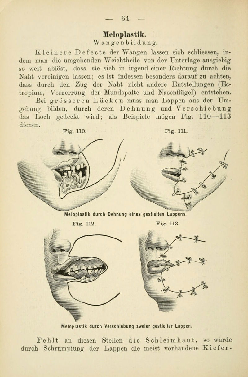 Meloplastik. Wangenbildung. Kleinere Defecte der Wangen lassen sicli schliessen, in- dem man die umgebenden Weiclitheile von der Unterlage ausgiebig so weit ablöst, dass sie sich in irgend einer Richtung durch die Naht vereinigen lassen; es ist indessen besonders darauf zu achten, dass durch den Zug der Naht nicht andere Entstellungen (Ec- tropium, Verzerrung der Mundsj)alte und Nasenflügel) entstehen. Bei grösseren Lücken muss man Lappen aus der Um- gebung bilden, durch deren Dehnung und Verschiebung das Loch gedeckt wird; als BeisjDiele mögen Fig. 110—113 dienen. Fig. 110. Fig. 111. Meloplastik durch Dehnung eines gestielten Lappens. Fig. 112. Fig. 113. Meloplastik durch Verschiebung zweier gestielter Lappen. Fehlt an diesen Stellen die Schleimhaut, so würde durch Schrumpfung der Lappen die meist vorhandene Kiefer-
