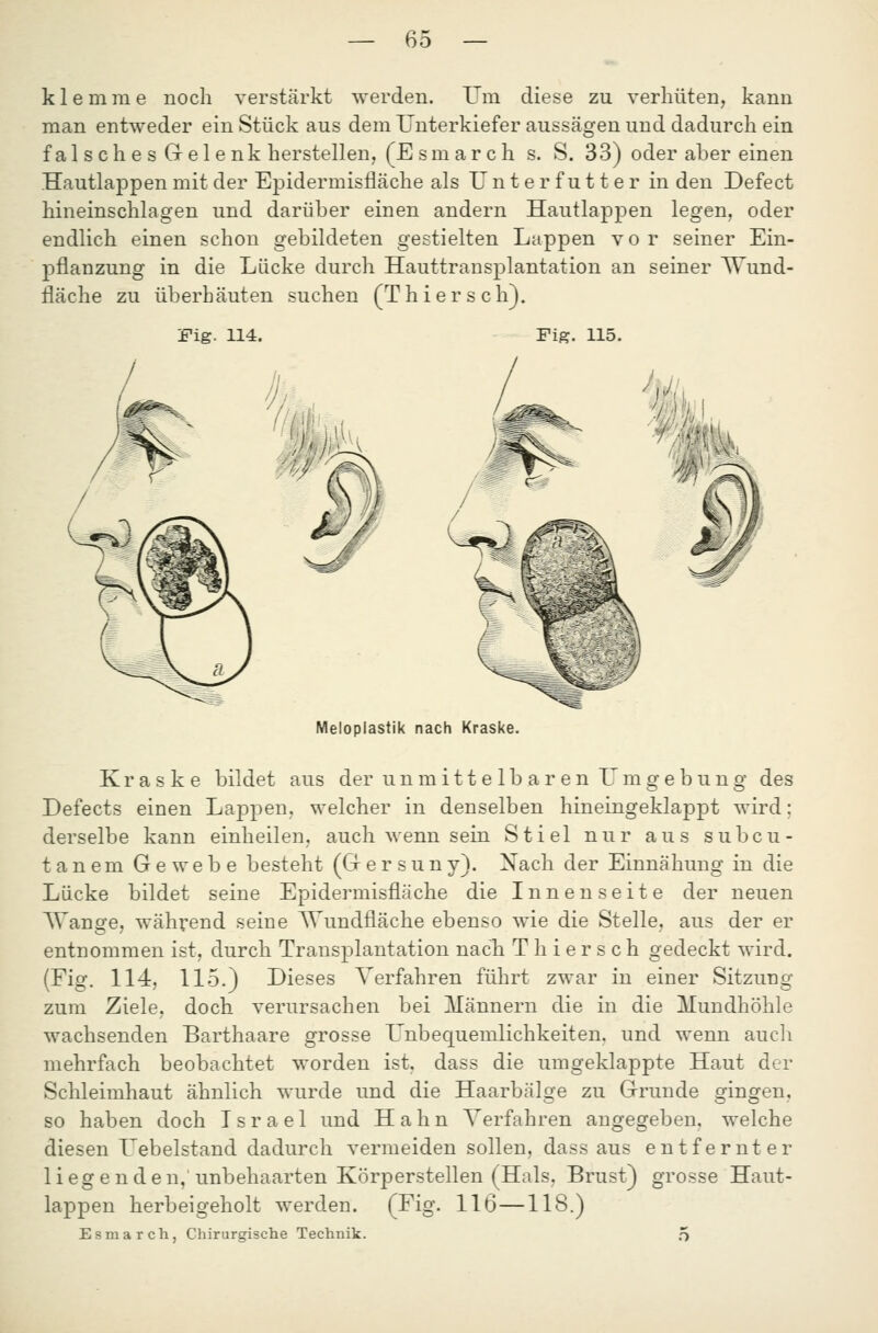 klemme noch verstärkt werden. Um diese zu verhüten, kann man entweder ein Stück aus dem Unterkiefer aussägen und dadurch ein fal s oh e s Grel e nk herstellen, (E sm arch s. S. 33) oder aber einen .Hautlappen mit der Ej)idermisfläche als Unterfutter in den Defect hineinschlagen und darüber einen andern Hautlappen legen, oder endlich einen schon gebildeten gestielten Lappen vor seiner Ein- pflanzung in die Lücke durch Hauttransplantation an seiner Wund- fläche zu überhäuten suchen (Thiersch). Fig. 114. Fig. 115. Meloplastik nach Kraske. K r a s k e bildet aus der unmittelbaren Umgebung des Defects einen Lappen, welcher in denselben hineingeklappt wird; derselbe kann einheilen, auch wenn sein Stiel nur aus subcu- tanem Gewebe besteht (G e r s u n y). Nach der Einnähung in die Lücke bildet seine Epidermisfläche die Innenseite der neuen AVange, wählend seine AVundfläche ebenso wie die Stelle, aus der er entnommen ist, durch Transplantation nacTi Thiersch gedeckt wird. (Fig. 114, 115.) Dieses Verfahren führt zwar in einer Sitzung zum Ziele, doch verursachen bei llännern die in die Mundhöhle wachsenden Barthaare grosse L'nbequemlichkeiten, und wenn aucli mehrfach beobachtet worden ist. dass die umgeklappte Haut der Schleimhaut ähnlich wurde und die Haarbälge zu Grunde gingen, so haben doch Israel und Hahn Verfahren angegeben, welche diesen Uebelstand dadurch vermeiden sollen, dass aus entfernter liegenden,'unbehaarten Körperstellen (Hals, Brust) grosse Haut- lappen herbeigeholt werden. (Fig. 116—118.) Esmarch, Chirurgische Technik. 5