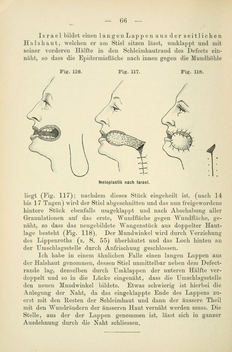 Israel bildet einen langenLapj)en aus der seitlichen Hals haut, welchen er am Stiel sitzen lässt, umklapjDt und mit seiner vorderen Hälfte in den Schleimhautrand des Defects ein- näht, so dass die Ej^idermisfläche nach innen gegen die Mundhöhle Fig. 116. Fig. 117. Fig. 118. Nieloplastik nach Israel. liegt (Fig. 117); nachdem dieses Stück eingeheilt ist. (nach 14 bis 17 Tagen) wird der Stiel abgeschnitten und das nun freigewordene hintere Stück ebenfalls umgeklappt und nach Abschabung aller Granulationen auf das erste, Wundfläche gegen Wundfläche, ge- näht, so dass das neugebildete Wangenstück aus doppelter Haut- lage besteht (Fig. 118). Der Mundwinkel wird durch Yerziehung des Lippenroths (s. S. 55) überhäutet und das Loch hinten an der Umschlagsstelle durch Anfrischung geschlossen. Ich habe in einem ähnlichen Falle einen langen Lappen aus der Halshaut genommen, dessen Stiel unmittelbar neben dem Defect- rande lag, denselben durch Umklappen der unteren Hälfte ver- doppelt und so in die Lücke eingenäht, dass die Umschlagsstelle den neuen Mundwinkel bildete. Etwas schwierig ist hierbei die Anlegung der Naht, da das eingeklappte Ende des LajDpens zu- erst mit den Resten der Schleimhaut und dann der äussere Theil mit den Wundrändern der äusseren Haut vernäht werden muss. Die Stelle, aus der der Lappen genommen ist, lässt sich in ganzer Ausdehnung durch die Naht schliessen.