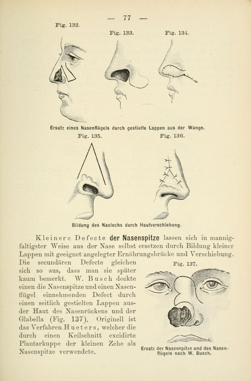 Fig. 132. Ersatz eines Nasenflügels durch gestielte Lappen aus der Wange. Fig. 135. Fig. 136. Fig. 137. Bildung des Naslochs durch Hautverschiebung. Kleinere Defecte der Nasenspitze lassen sich in mannig- faltiofster Weise aus der Nase selbst ersetzen durch Bildunof kleiner Lappen mit geeignet angelegter Ernährungsbrücke und Verschiebung. Die secundären Defecte gleichen sich so aus, dass man sie später kaum bemerkt. W. Busch deckte einen die Nasenspitze und einen Nasen- flügel einnehmenden Defect durch einen seitlich gestielten Lappen aus- der Haut des Nasenrückens und der Glabella (Fig. 137). Originell ist das Verfahren H u e t e r s , welcher die durch einen Keilschnitt excidirte Plantarkuppe der kleinen Zehe als ■XT -i 1 j Ersatz der Nasenspitze und des Nasen- Nasenspitze verwendete. flügeis nach w. Busch.