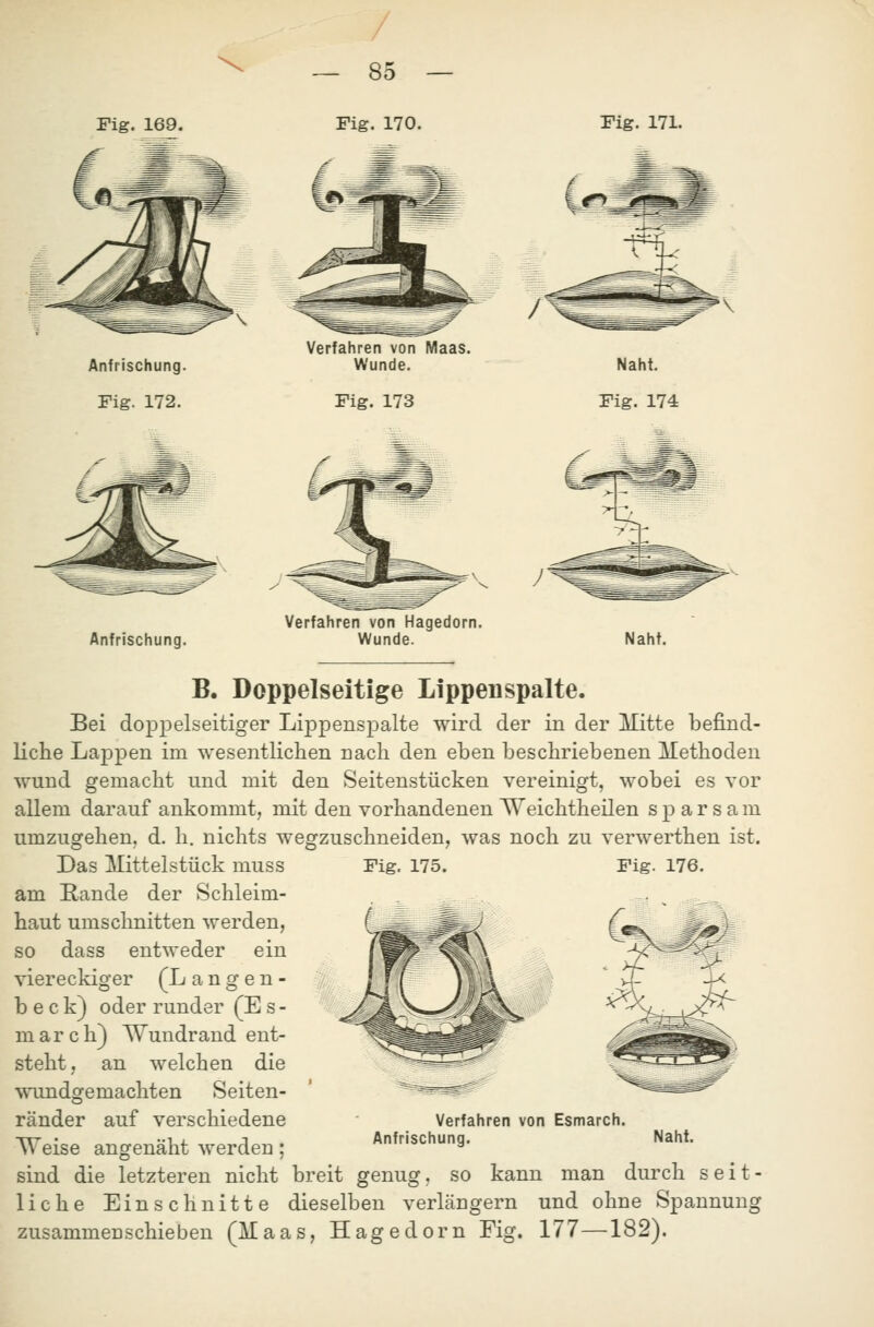 / Pig. 169. Pig. 171. Anfrischung. Fig. 172. Verfahren von Maas. Wunde. Fig. 173 Naht. Fig. 174 Anfrischung. Verfahren von Hagedorn. Wunde. Naht. Fig. 175. Fig. 176. B. Doppelseitige Lippen spalte. Bei doppelseitiger Lippenspalte wird der in der lUitte befind- liche Lappen im wesentlichen nach den eben beschriebenen Methoden wund gemacht und mit den Seitenstücken vereinigt, wobei es vor allem darauf ankommt, mit den vorhandenen Weichtheilen sparsam umzugehen, d. h. nichts wegzuschneiden, was noch zu verwerthen ist. Das Mittelstück muss am Rande der Schleim- haut umschnitten werden, so dass entweder ein viereckiger (Langen- b e c k) oder runder (E s - m ar c h) Wundrand ent- steht, an welchen die wundgemachten Seiten- ränder auf verschiedene Weise angenäht werden ; sind die letzteren nicht breit genug, so kann man durch seit- liche Einschnitte dieselben verlängern und ohne Spannung zusammenschieben (Maas, Hagedorn Fig. 177—182). Verfahren von Esmarch.