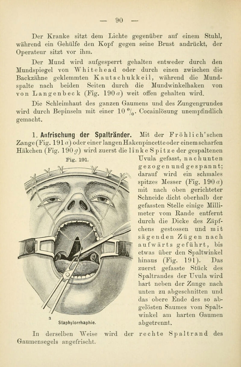 Der Kranke sitzt dem Lichte gegenüber auf einem Stuhl, während ein Gehülfe den Kopf gegen seine Brust andrückt, der Operateur sitzt vor ihm. Der Mund wird aufgesperrt gehalten entweder durch den Mundspiegel von AVhitehead oder durch einen zwischen die Backzähne geklemmten Kautschukkeil, während die Mund- spalte nach beiden Seiten durch die Mundwinkelhaken von von Langenbeck (Fig. 190a) weit offen gehalten wird. Die Schleimhaut des ganzen Gaumens und des Zungengrundes wird durch Bepinseln mit einer 10 ^/q. Cocainlösung unemj^findlich gemacht. Fig. 191. 1. Anfrischung der Spaltränder. Mit der Fröhlich'schen Zange (Fig. 191«) oder einer langen Hakenpincette oder einem scharfen Häkchen (Fig. 190g^ wird zuerst die linke Spitze der gespaltenen Uvula gefasst, nach unten gezogen und ge spannt; darauf wird ein schmales spitzes Messer (Fig. 190 «) mit nach oben gerichteter Schneide dicht oberhalb der gefassten Stelle einige Milli- meter vom Rande entfernt durch die Dicke des Zäpf- chens gestossen und mit sägenden Zügen nach aufwärts geführt, bis etwas über den Sj^altwinkel hinaus (Fig. 191). Das zuerst gefasste Stück des Spaltrandes der Uvula wird hart neben der Zunge nach unten zu abgeschnitten und das obere Ende des so ab- gelösten Saumes vom Spalt- winkel am harten Gaumen abgetrennt. In derselben Weise wird der rechte Spaltrand des Gaumensegels ansfefrischt. Staphylorrhaphie.