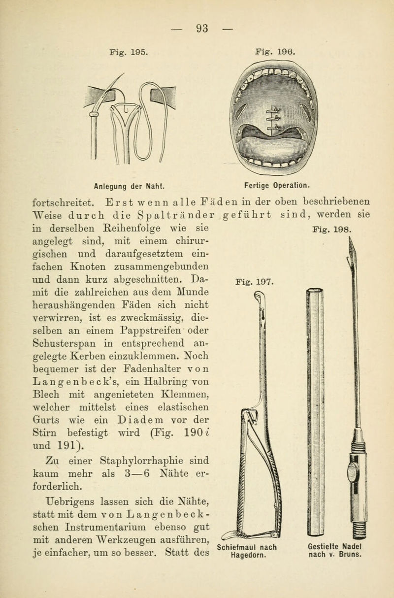 Fig. 195. Fig. 196. Anlegung der Naht. Fertige Operation. fortschreitet. Erst wenn alle Fäden in der oben beschriebenen Weise durch die Spaltränder geführt sind, werden sie Fig. 197. f1 in derselben Reihenfolge wie sie angelegt sind, mit einem chirur- gischen und daraufgesetztem ein- fachen Knoten zusammengebunden und dann kurz abgeschnitten. Da- mit die zahlreichen aus dem Munde heraushängenden Fäden sich nicht verwirren, ist es zweckmässig, die- selben an einem Pappstreifen oder Schusterspan in entsprechend an- gelegte Kerben einzuklemmen. Noch bequemer ist der Fadenhalter von Langenbeck's, ein Halbring von Blech mit angenieteten Klemmen, welcher mittelst eines elastischen Gurts wie ein Diadem vor der Stirn befestigt wii'd (Fig. 190 ^ und 191). Zu einer Staphylorrhaphie sind kaum mehr als 3—6 Nähte er- forderlich. TJebrigens lassen sich die Nähte, statt mit dem von Langenbeck- schen Instrumentarium ebenso gut mit anderen Werkzeugen ausführen, • n 1 1 Oi. xj. j Schiefmaul nach je emiacner, um so besser, otatt des Hagedorn. Fig. 198. Gestielte Nadel nach V. Bruns.