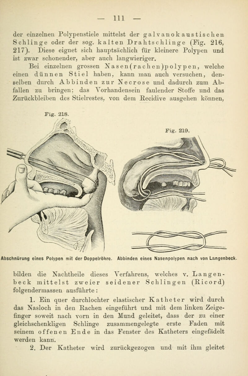 — In- der einzelnen Polypenstiele mittelst der galvanok austischen Schlinge oder der sog. kalten Drahtschlinge (Fig. 216, 217). Diese eignet sich hauptsächlich für kleinere Polypen und ist zwar schonender, aber auch langwieriger. Bei einzelnen grossen Nasen(racheu)j)olypen, welche einen dünnen Stiel haben, kann man auch versuchen, den- selben durch Abbinden zur Necrose und dadurch zum Ab- fallen zu bringen: das Vorhandensein faulender Stoffe und das Zurückbleiben des Stielrestes, von dem Recidive ausgehen können, Fig. 218. Fig. 219. Abschnürung eines Polypen mit der Doppelröhre. Abbinden eines Nasenpolypen nach von Langenbeck. bilden die Nachtheile dieses Verfahrens, welches v. Langen- beck mittelst zweier seidener Schlingen (E, i c o r d) folgendermassen ausführte: 1. Ein quer durchlochter elastischer Katheter wird durch das Nasloch in den Rachen eingeführt und mit dem linken Zeige- finger soweit nach vorn in den JVlund geleitet, dass der zu einer gleichschenkligen Schlinge zusammengelegte erste Faden mit seinem offenen Ende in das Fenster des Katheters eingefädelt werden kann. 2. Der Katheter wird zurückgezogen und mit ihm gleitet