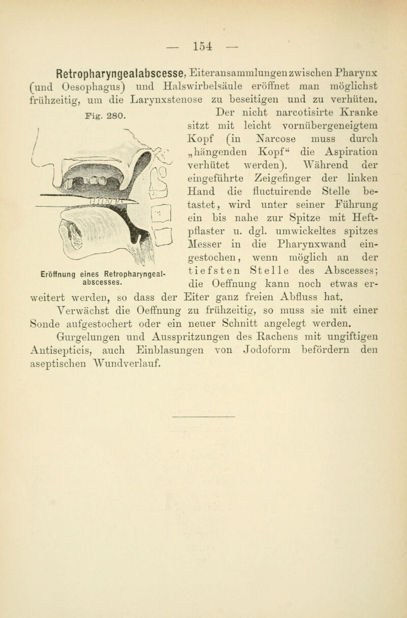 Fig. 280. RetropharyngGalabSCeSSG, Eiteransammlungen zwischen Pharynx (und Oesophagus) und Halswirbelsäule eröffnet man möglichst frühzeitig, um die Larynxstenose zu beseitigen und zu verhüten. Der nicht narcotisirte Kranke sitzt mit leicht vornübergeneigtem Kopf (in Narcose muss durch „hängenden Kopf die Aspiration verhütet werden). Während der eingeführte Zeigefinger der linken Hand die fluctuirende Stelle be- tastet, wird unter seiner Führung ein bis nahe zur Spitze mit Heft- pflaster u. dgl. umwickeltes spitzes Messer in die Pharynxwand ein- gestochen , wenn möglich an der tiefsten Stelle des Abscesses; die OefFnung kann noch etwas er- weitert werden, so dass der Eiter ganz freien Abfluss hat. Verwächst die Oeffnung zu frühzeitig, so muss sie mit einer Sonde aufgestochert oder ein neuer Schnitt angelegt werden. Gurgelungen und Ausspritzungen des Rachens mit ungiftigen Antisepticis, auch Einblasungen von Jodoform befördern den aseptischen AVundverlauf. Eröffnung eines Retropharyngeal- abscesses.