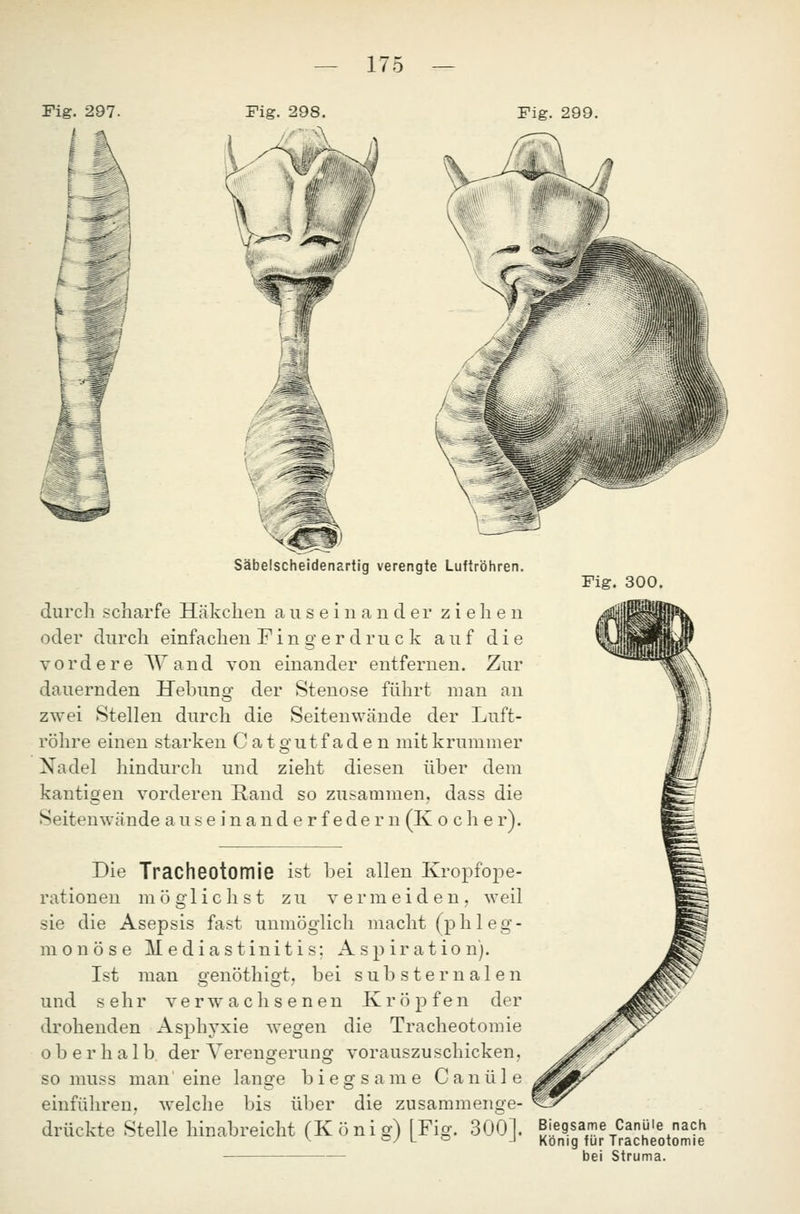 Fig. 298. Fig. 299. Säbelscheidenartig verengte Luftröhren. durch scharfe Häkchen auseinander ziehen oder durch einfachen Pin g e r dru c k auf die vordere Wand von einander entfernen. Zur dauernden Hebung der Stenose führt man an zwei Stellen durch die Seitenwände der Luft- röhre einen starken Cat gutfaden mit krummer Nadel hindurch und zieht diesen über dem kantigen vorderen Rand so zusammen, dass die Seitenwände auseinanderfedern (K o c h e r). Fig. 300. Die Tracheotomie ist bei allen Kropfope- rationen möglichst zu vermeiden, weil sie die Asepsis fast unmöglich macht (phleg- monöse Mediastinitis; Aspiration). Ist man genöthigt, bei substemalen und sehr verwachsenen KröjDfen der drohenden Asphyxie wegen die Tracheotomie oberhalb der Verengerung vorauszuschicken. so muss man eine lange biegsame Canüle einführen, welche bis über die zusammenge- drückte Stelle hinabreicht (König) [Fig. 3001. Bi.e9.saie ( ^ oy L o j Konig für T Canüle nach racheotomie bei Struma.