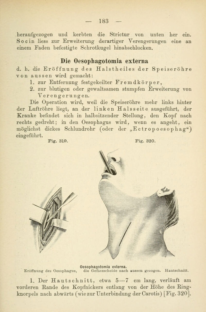 heraufgezogen und kerbten die Strictur von unten her ein. So ein Hess zur Erweiterung derartiger Verengerungen eine an einem Faden befestigte Schrotkugel hinabschlucken. Die Oesophagotomia externa d. h. die Eröffnung des Halstheiles der Speiseröhre von aussen wird gemacht: 1. zur Entfernung festgekeilter Fremdkörper, 2. zur blutigen oder gewaltsamen stumpfen Erweiterung von Verengerungen. Die Operation wird, weil die Speiseröhre mehr links hinter der Luftröhre liegt, an der linken Halsseite ausgeführt, der Kranke befindet sich in halbsitzender Stellung, den Kopf nach rechts gedreht; in den Oesophagus wird, wenn es angeht, ein möglichst dickes Schlundrohr (oder der ..Ectropoesophag} eingeführt. Fig. 319. Fig. 320. Oesophagotomia externa. Eröffnung des Oesophagus, die Gefässscheicle nach aussen gezogen. Hautschnitt. 1. Der Hautschnitt, etwa 5—7 cm lang, verläuft am vorderen Rande des Kopfnickers entlang von der Höhe des Ring- knorpels nach abwärts (wie zur Unterbindung der Carotis) [Fig. 320].